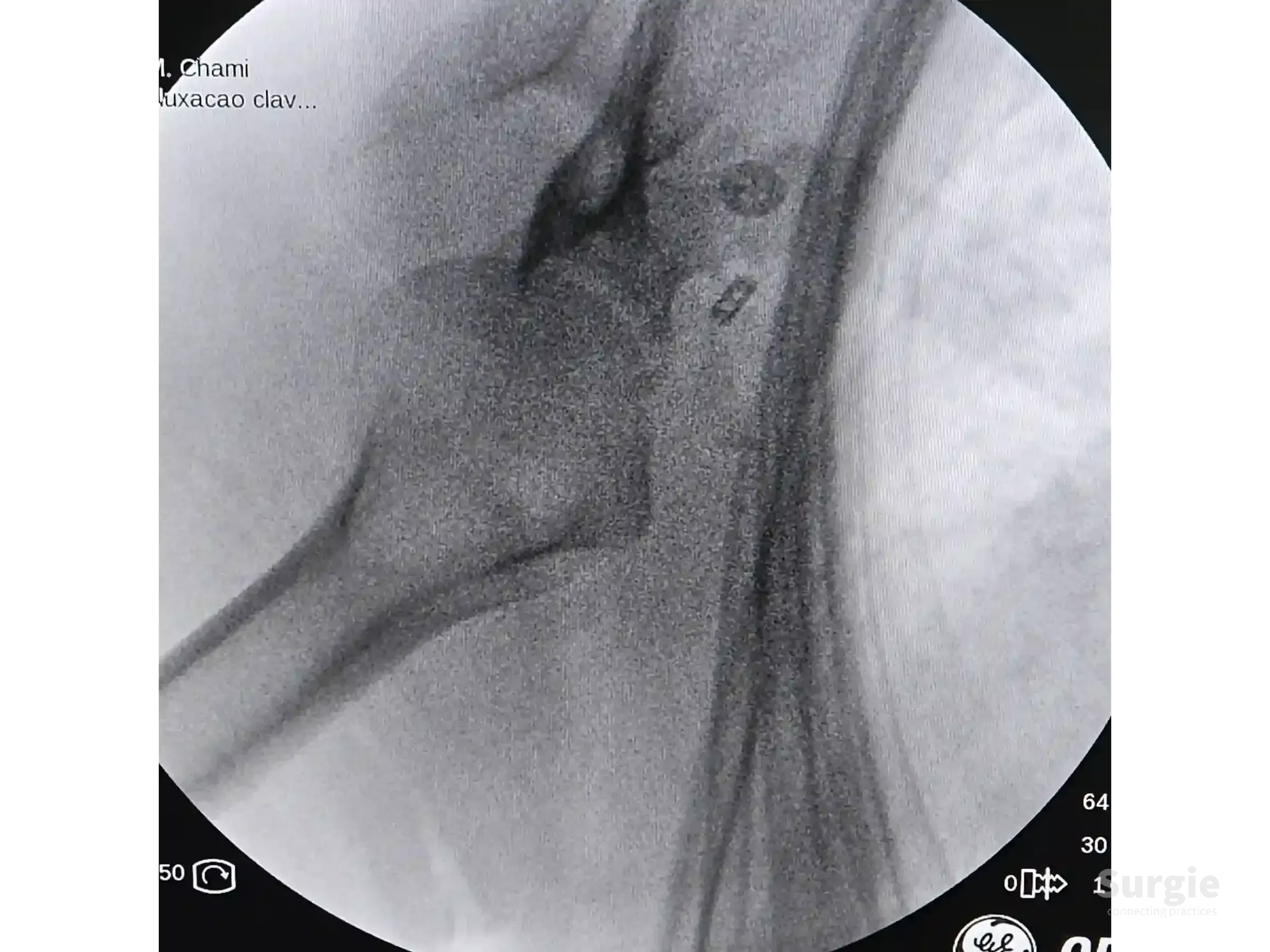Fluoroscopic X-ray showing TightRope fixation of an acromioclavicular joint dislocation with metallic button implants.