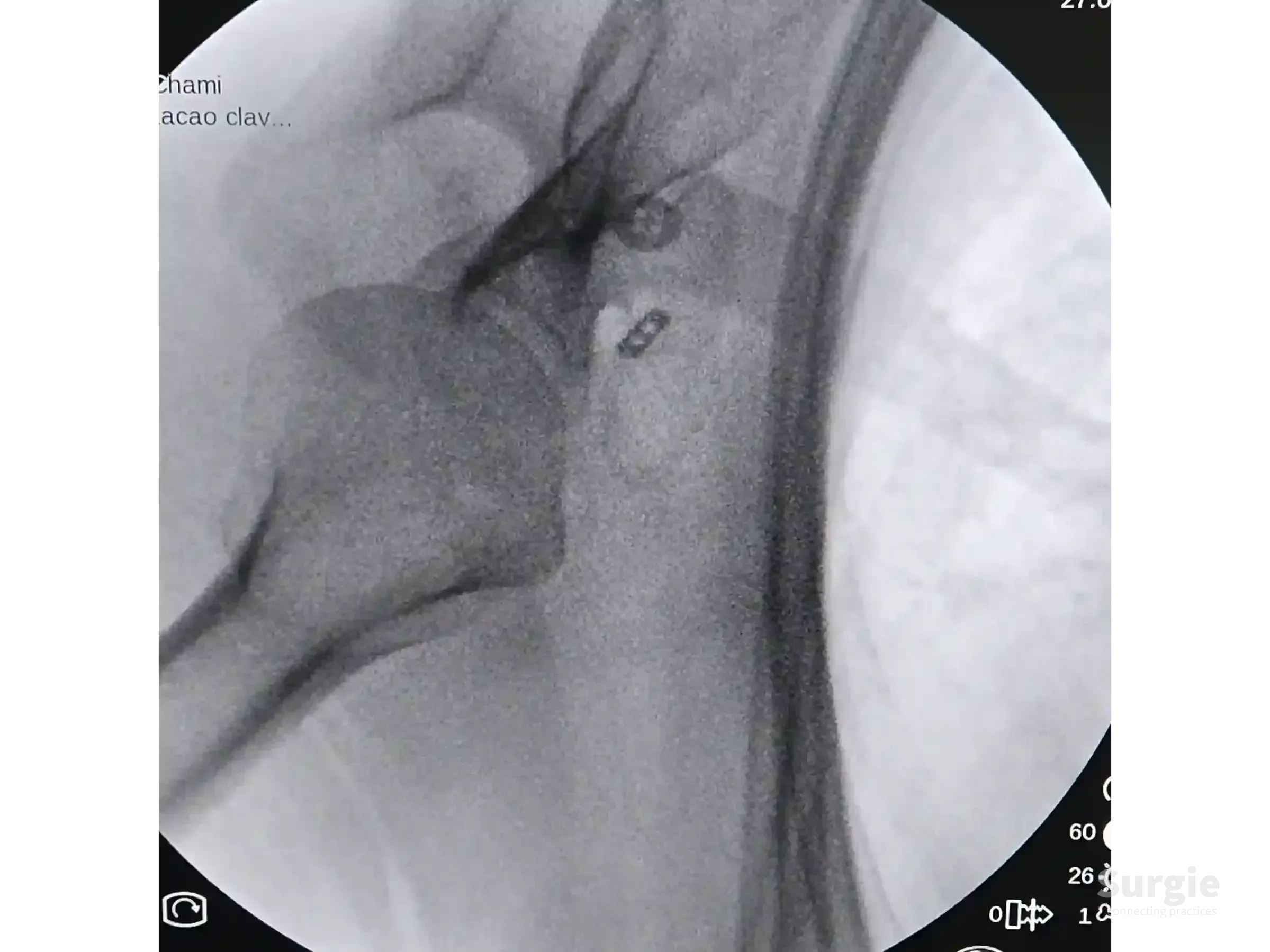 Fluoroscopic X-ray showing a TightRope fixation device securing the clavicle and coracoid process for AC joint repair.