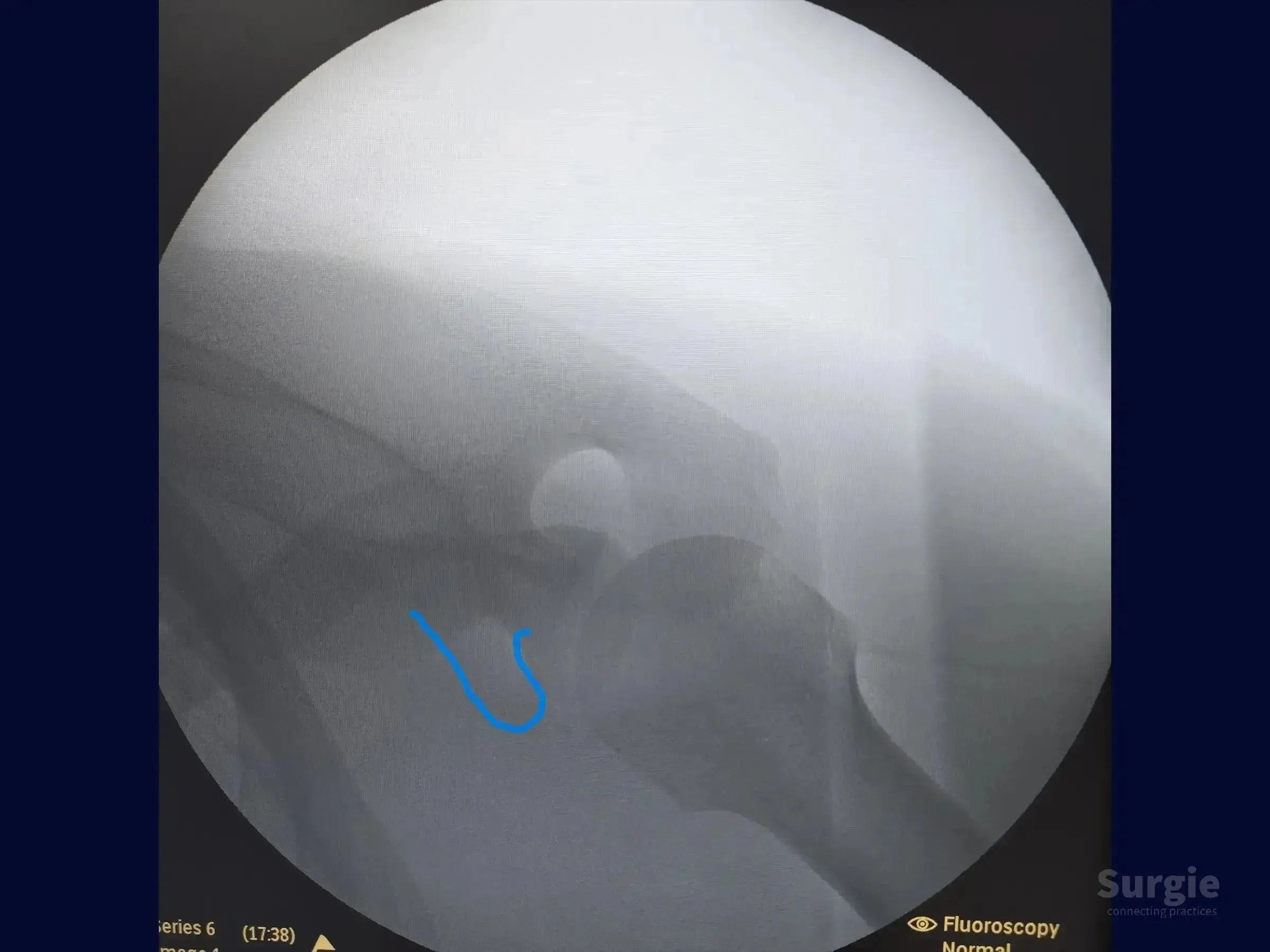 Fluoroscopic X-ray showing acromioclavicular joint with a blue digital guide mark for TightRope device placement.