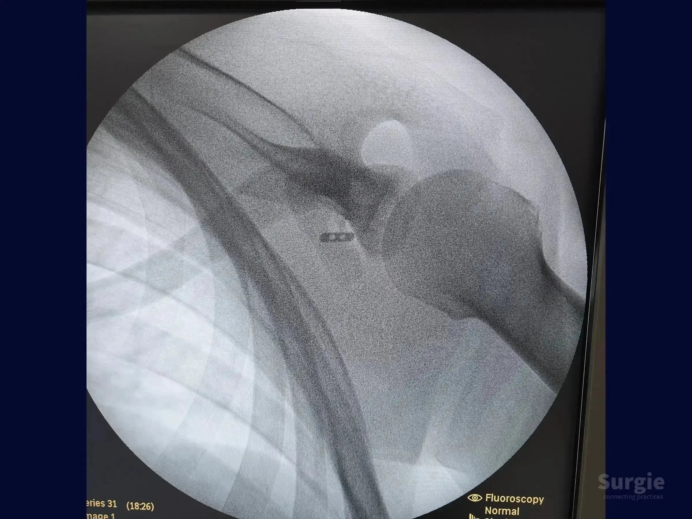 Fluoroscopic X-ray showing a TightRope device stabilizing an acromioclavicular joint dislocation in the shoulder.