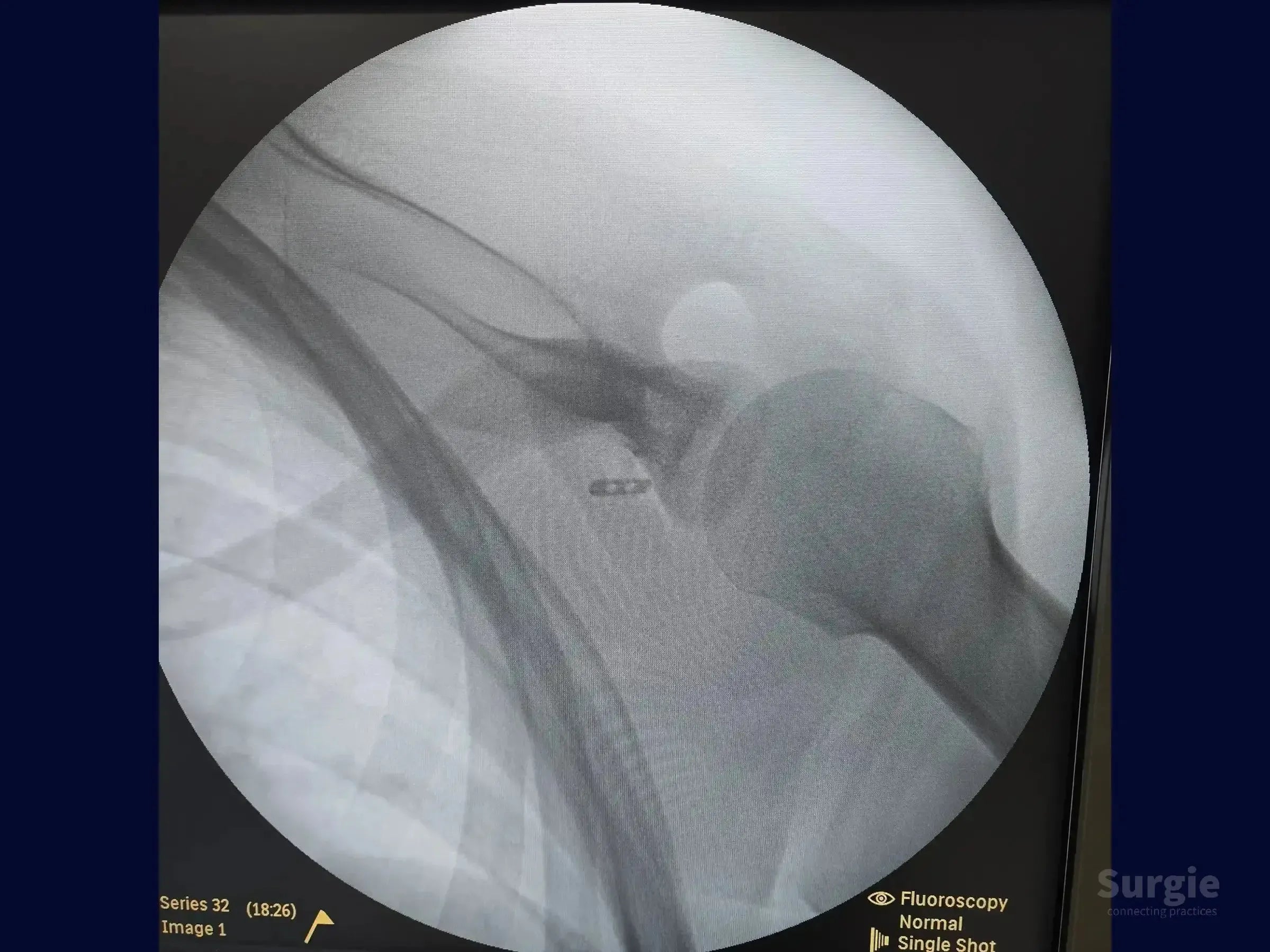 Fluoroscopic X-ray showing a TightRope device implanted in the shoulder for acromioclavicular dislocation stabilization.