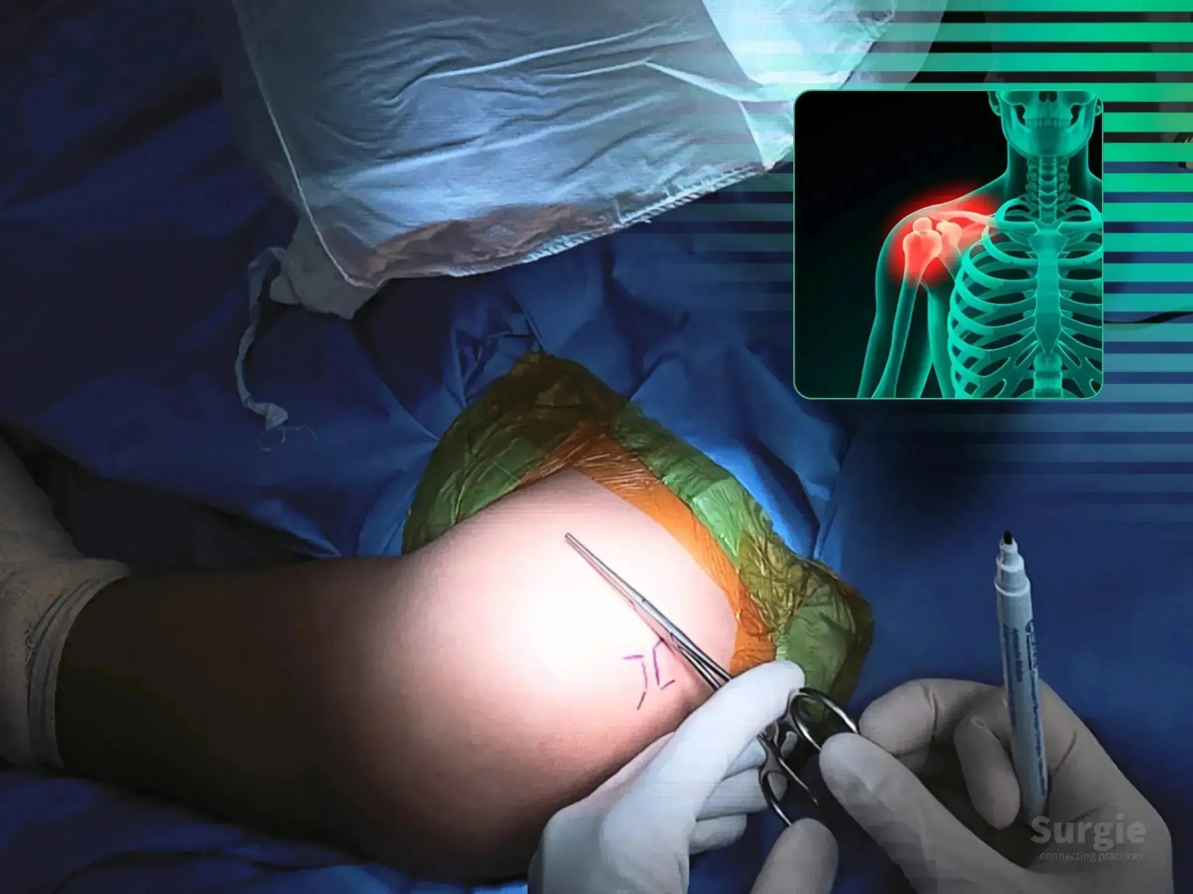 Surgeon marking shoulder skin for TightRope AC joint reconstruction with an anatomical overlay showing dislocation.