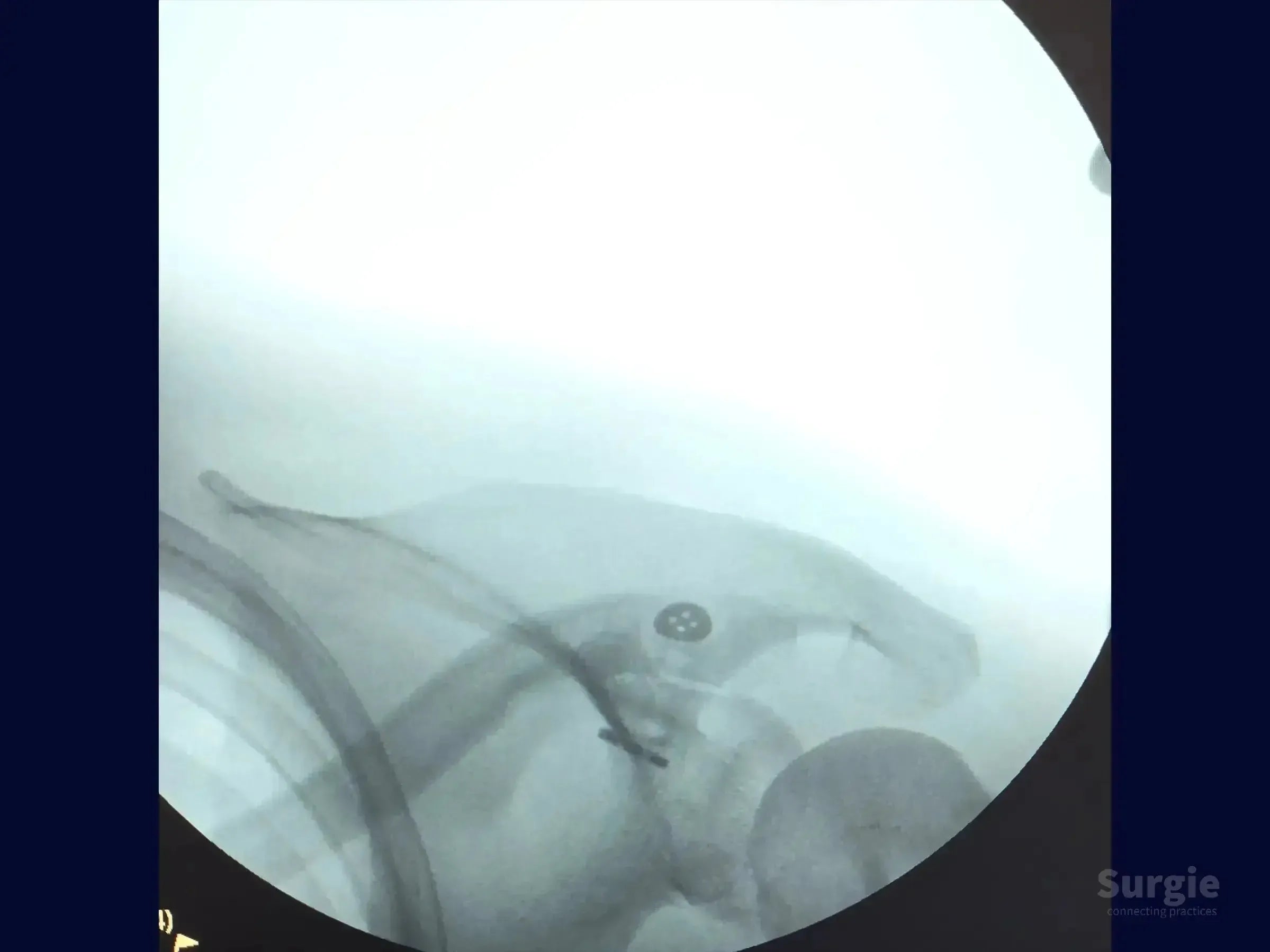 Fluoroscopic view of a TightRope device stabilizing an acromioclavicular joint dislocation with a metallic button.