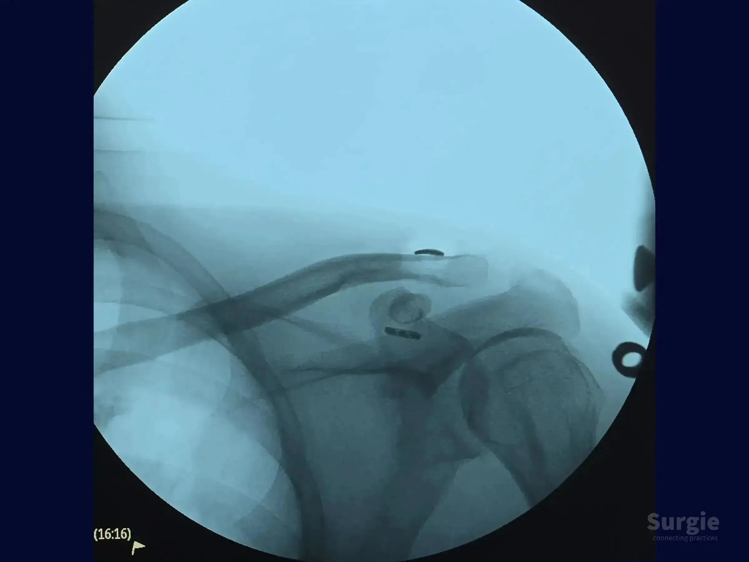 Fluoroscopic X-ray showing TightRope device stabilization of the acromioclavicular joint with bone tunnel fixation.