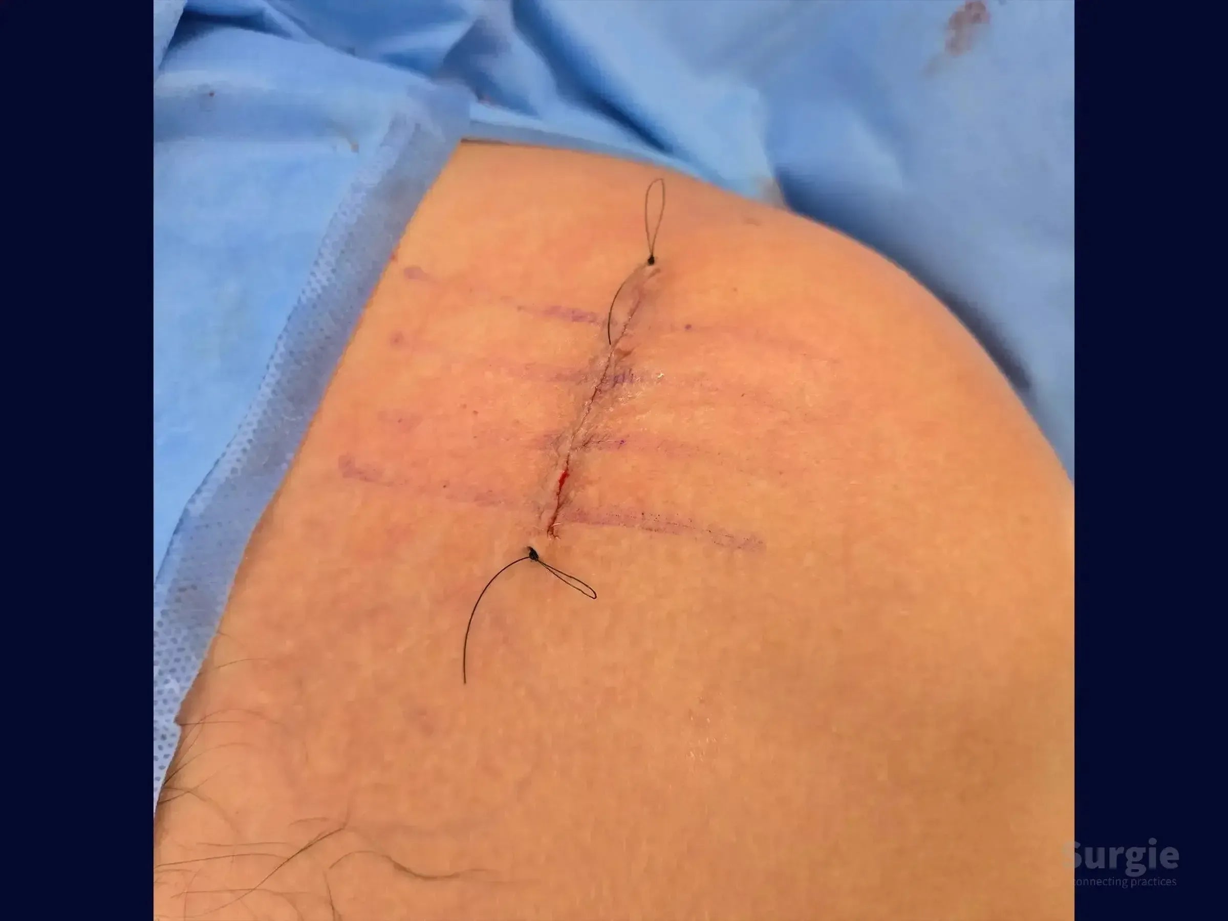 Surgical incision on the shoulder with purple guide marks and black sutures for acromioclavicular joint stabilization.