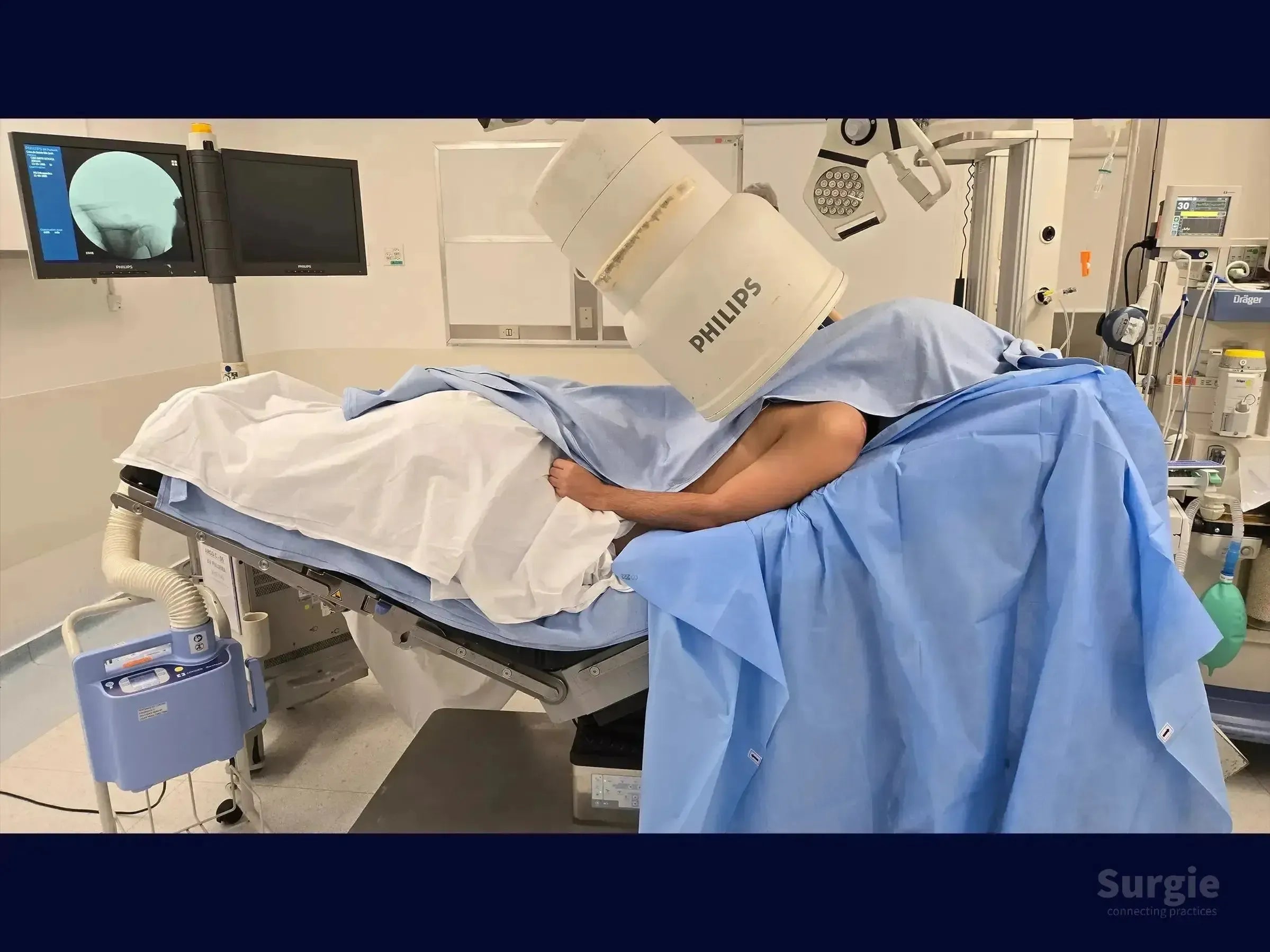 Patient on operating table under a Philips C-arm fluoroscope for acromioclavicular joint surgery with blue surgical drapes.