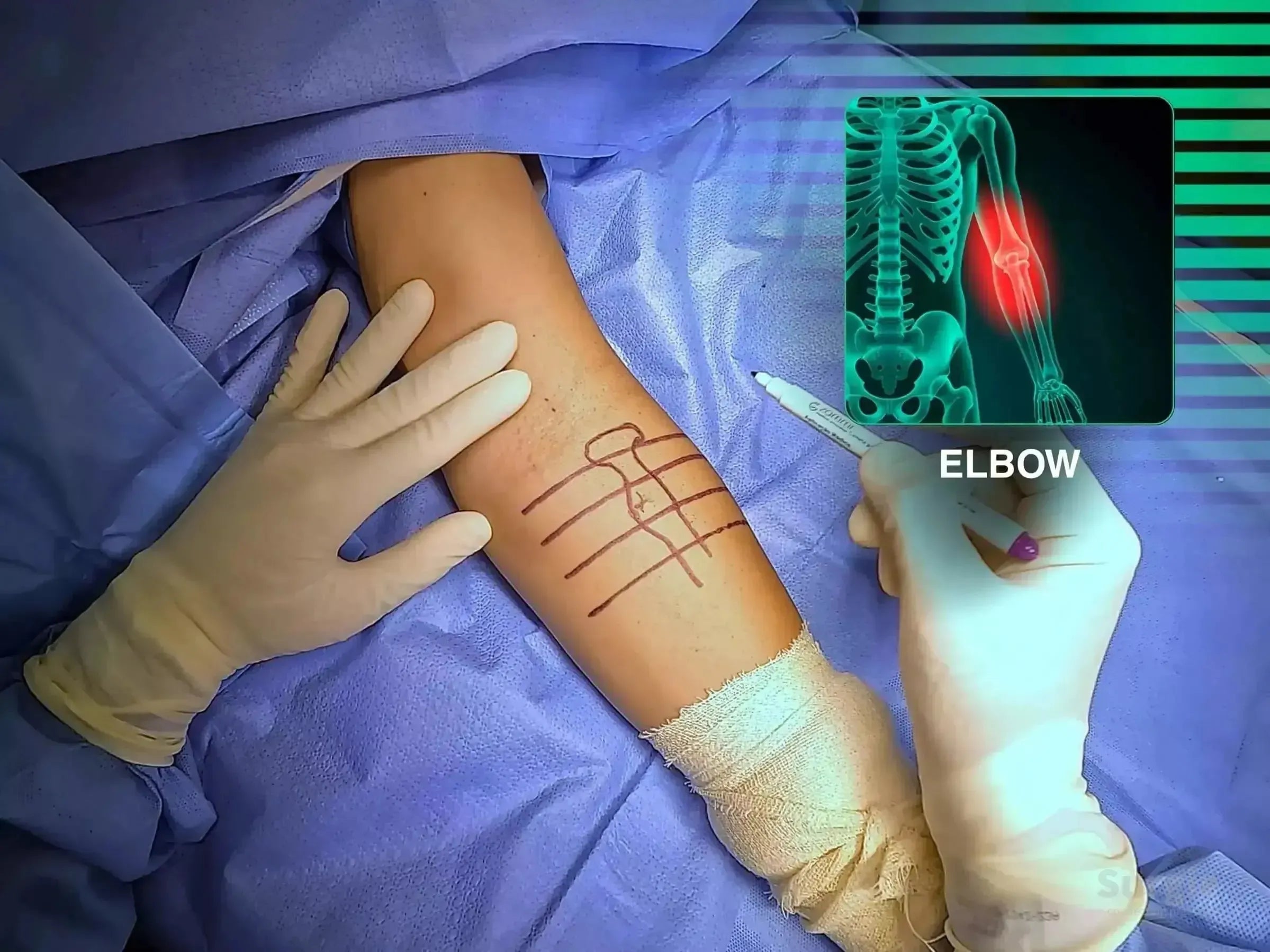 Surgeon marking a patient's arm for distal biceps tendon reconstruction with an anatomical elbow reference overlay.