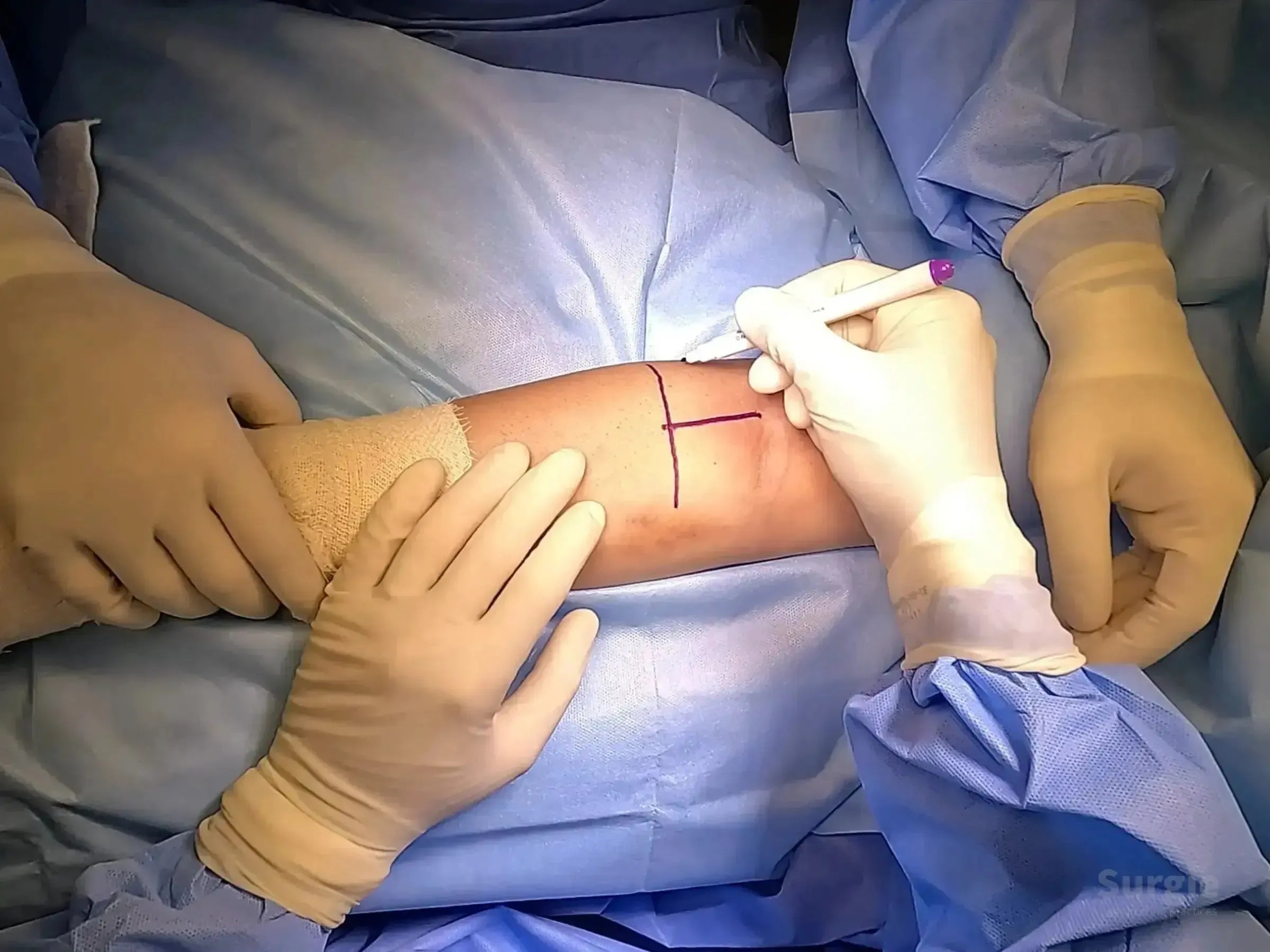 Surgeon in sterile gloves marking a T-shaped incision line on a patient's arm for distal biceps tendon reconstruction.
