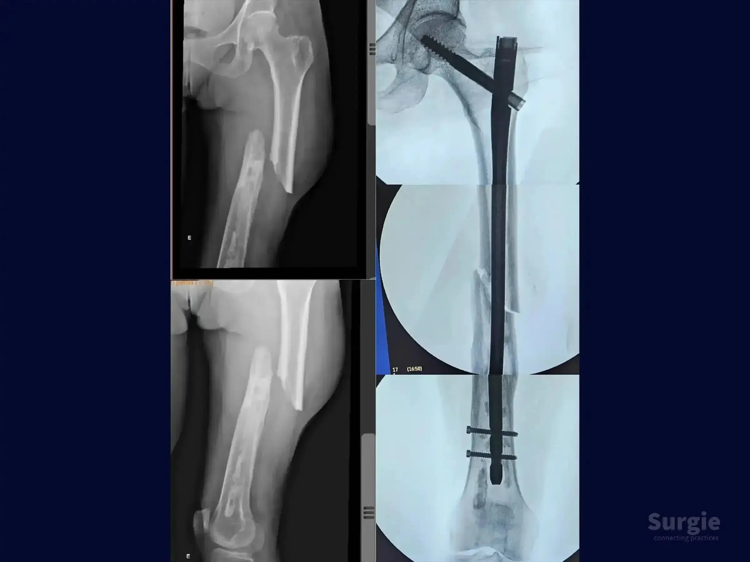 X-ray showing a femoral shaft fracture treated with an anterograde cephalomedullary intramedullary nail and distal locking.