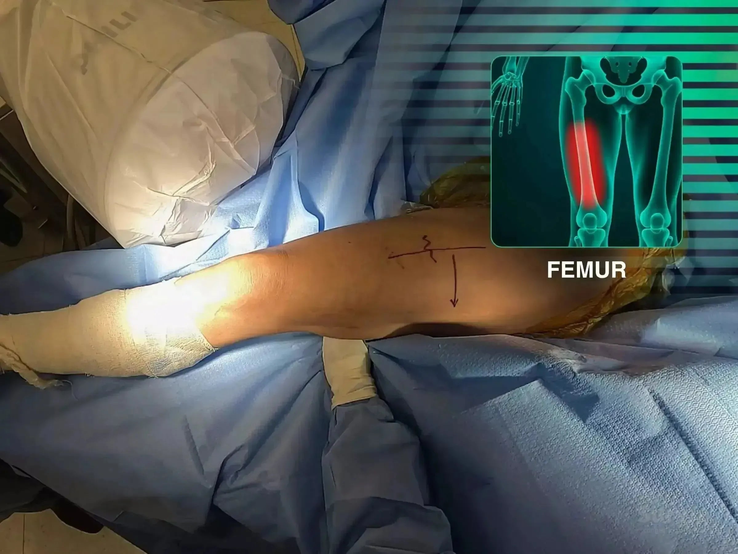 Surgical preparation of a patient's thigh for cephalomedullary nail fixation with a femoral anatomy overlay.