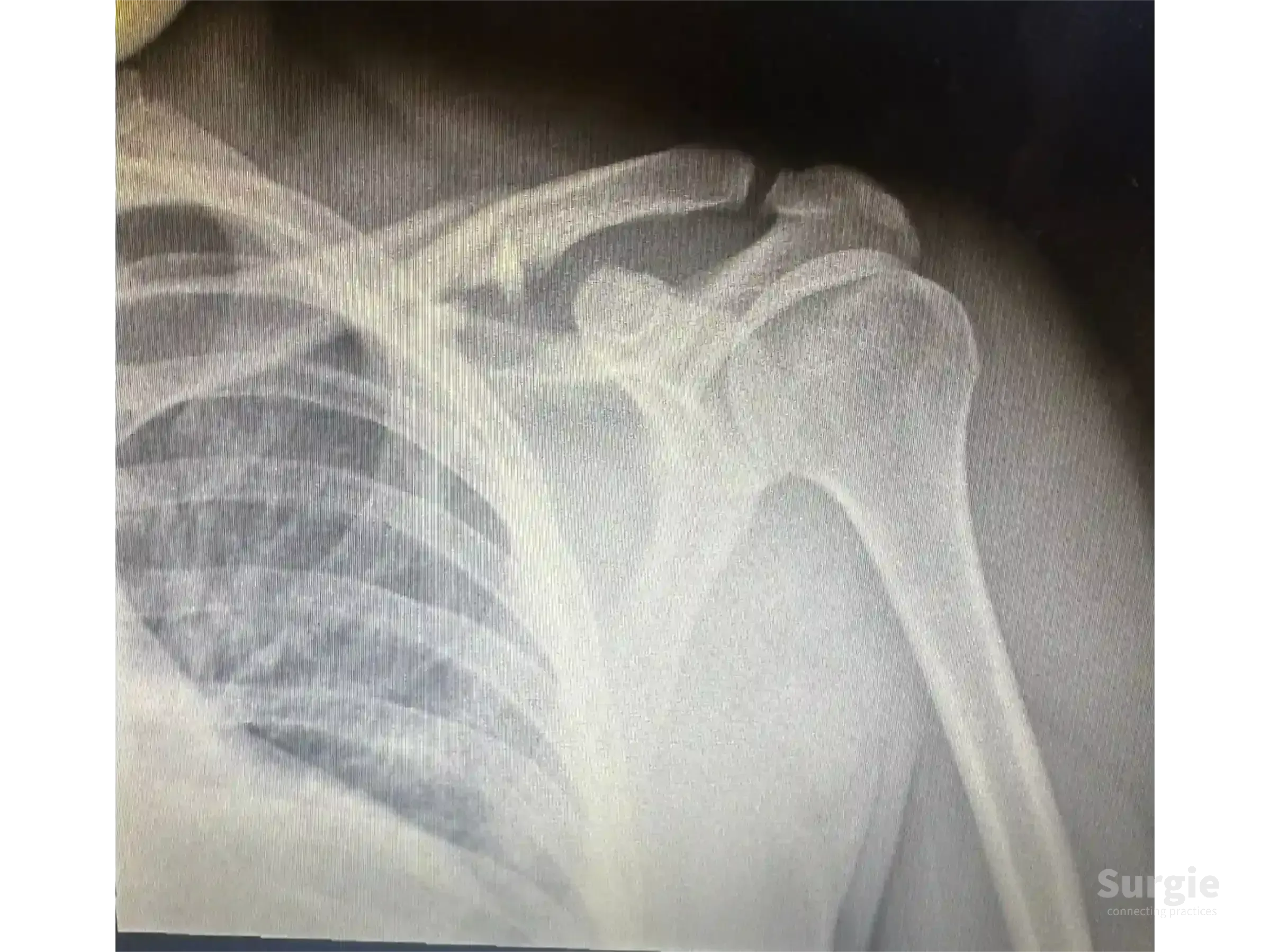 X-ray showing a midshaft clavicle fracture with shoulder anatomy for orthopedic surgical planning.