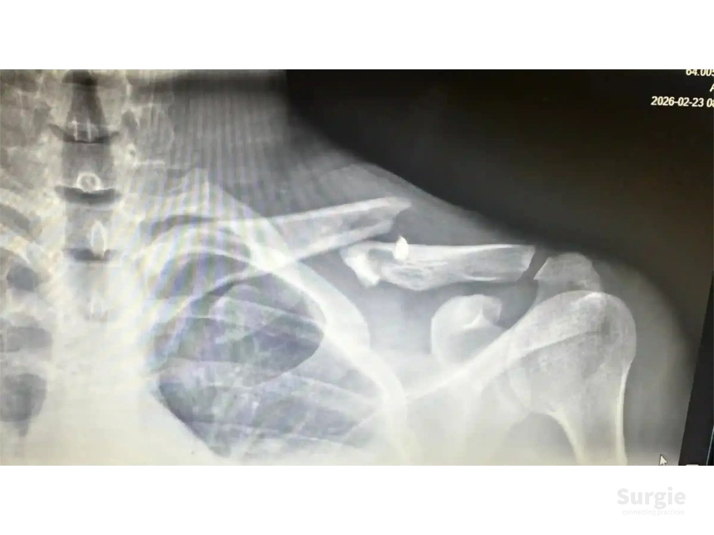 X-ray showing a midshaft clavicle fracture with a metallic fixation screw in a grayscale medical imaging display.