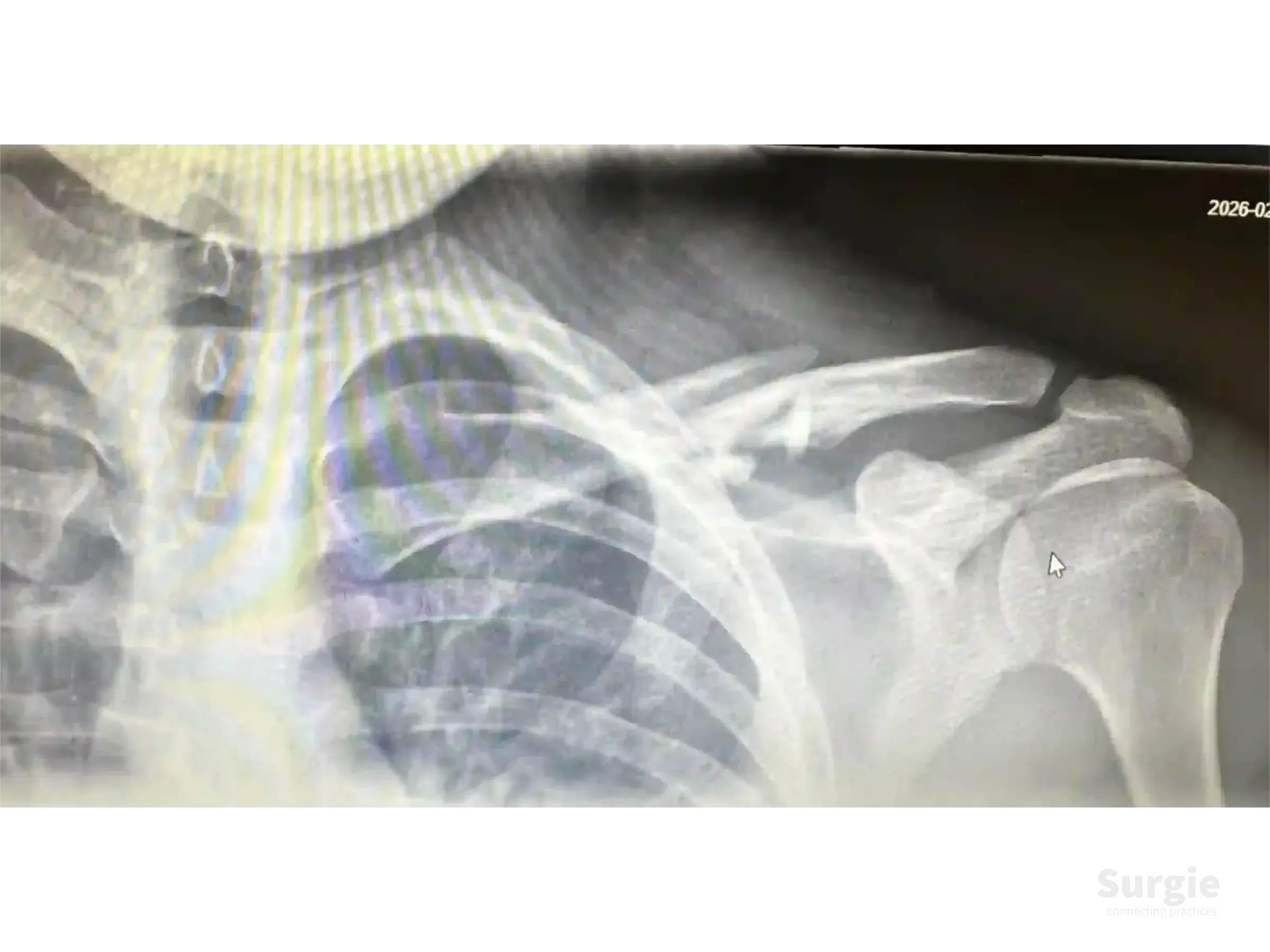 Grayscale X-ray showing a midshaft clavicle fracture with displacement and bone fragmentation in the shoulder area.