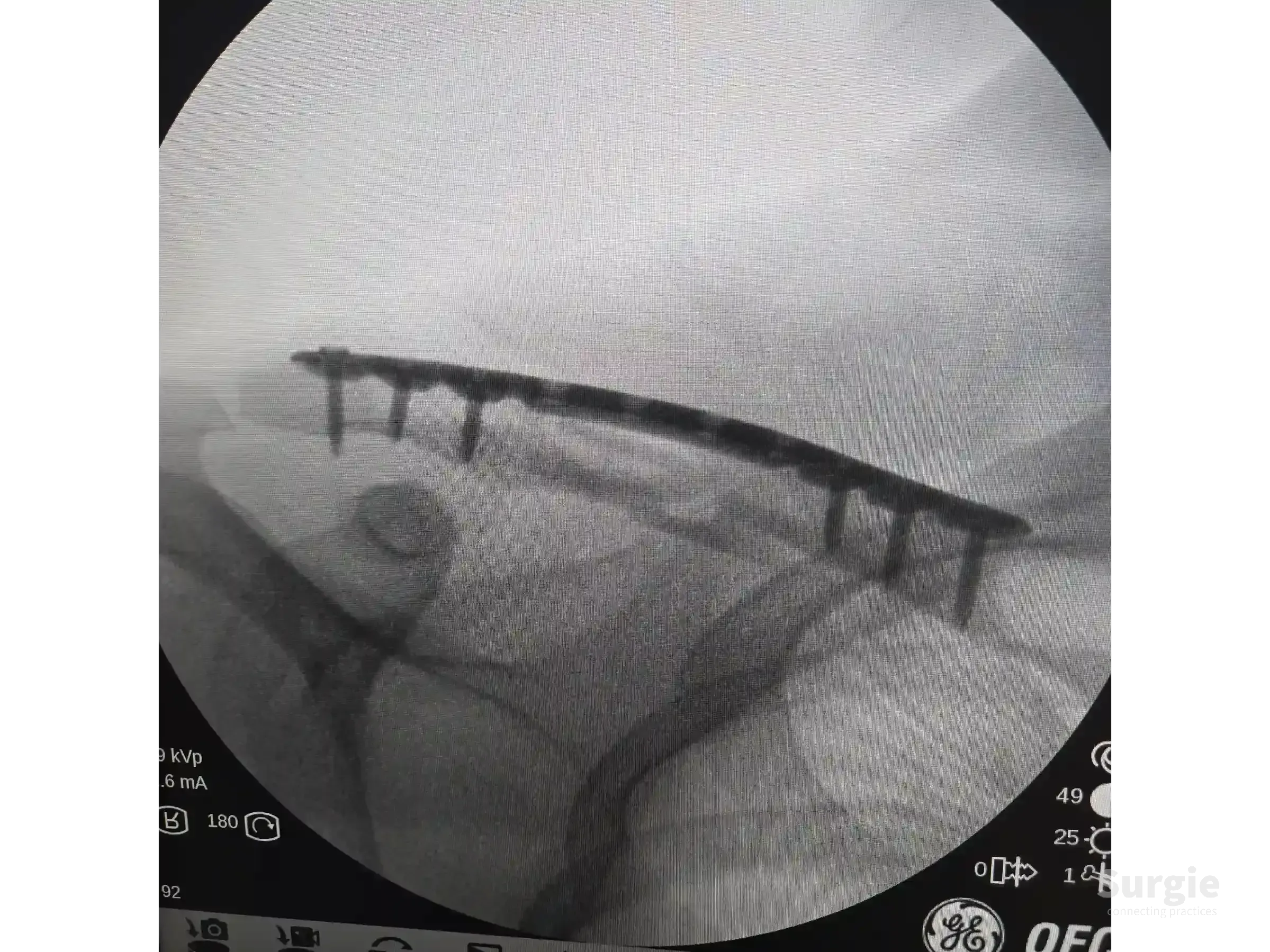 Fluoroscopic view of a clavicle fracture fixed with a metallic bridge plate and screws in a minimally invasive procedure.