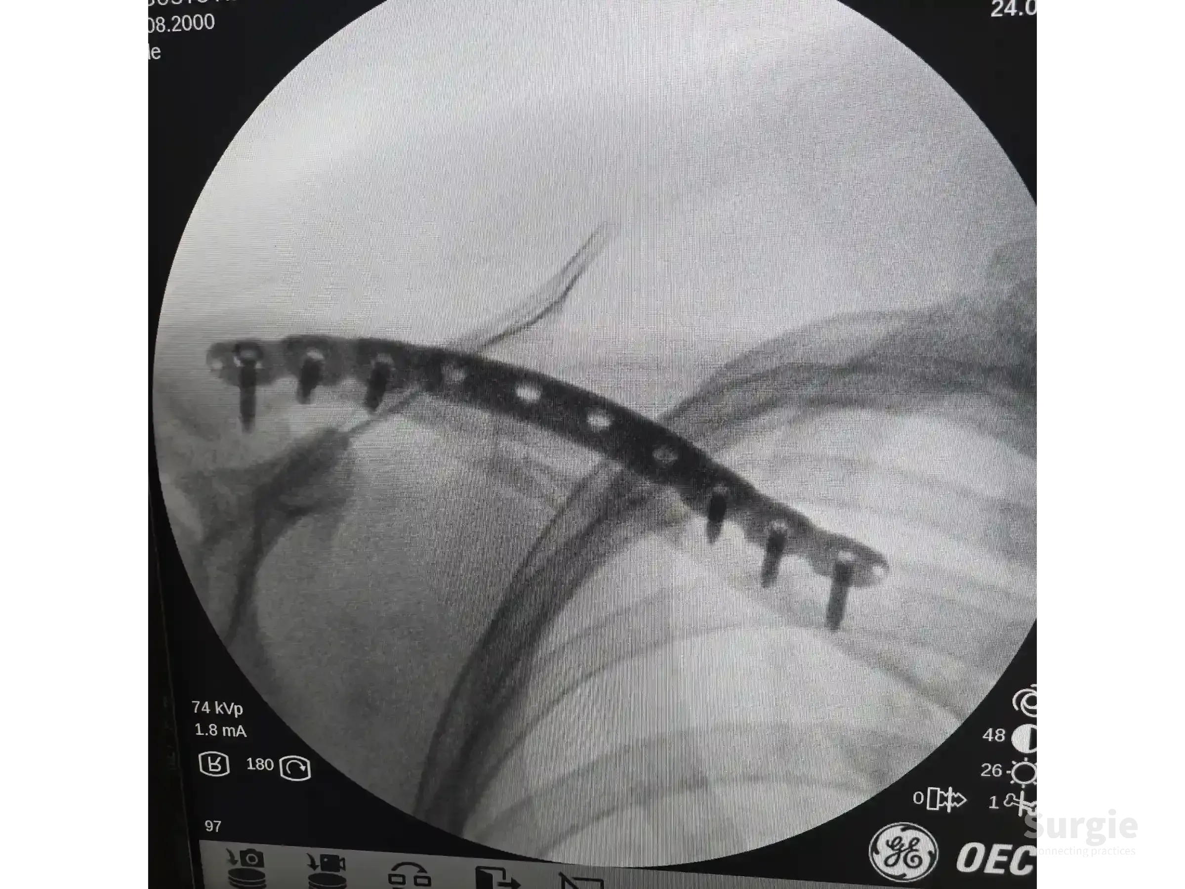 Fluoroscopic view of a clavicle fracture fixed with a percutaneous metal plate and screws in a beach-chair position.