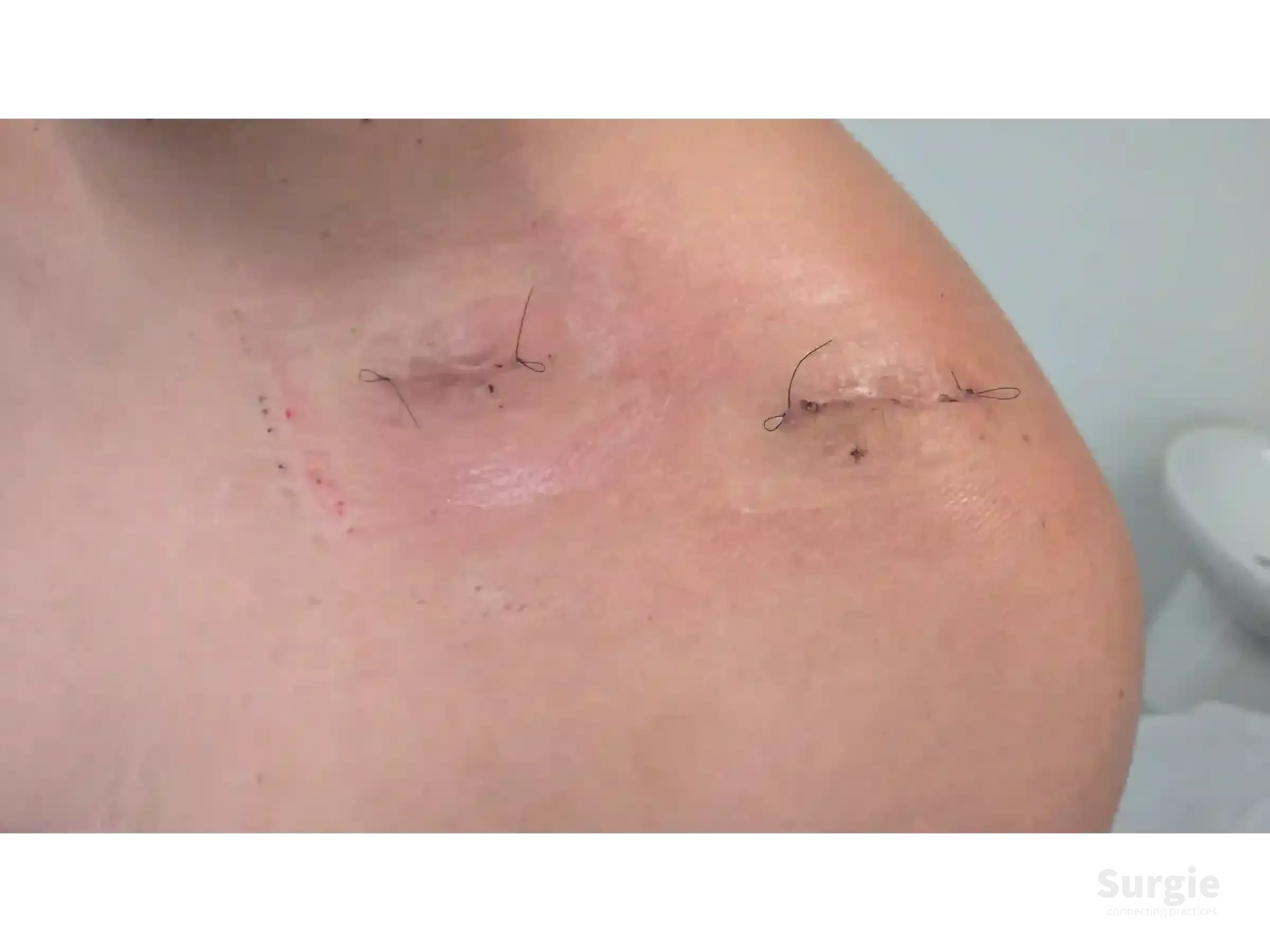 Two small surgical incisions on the clavicle closed with black sutures after minimally invasive osteosynthesis.