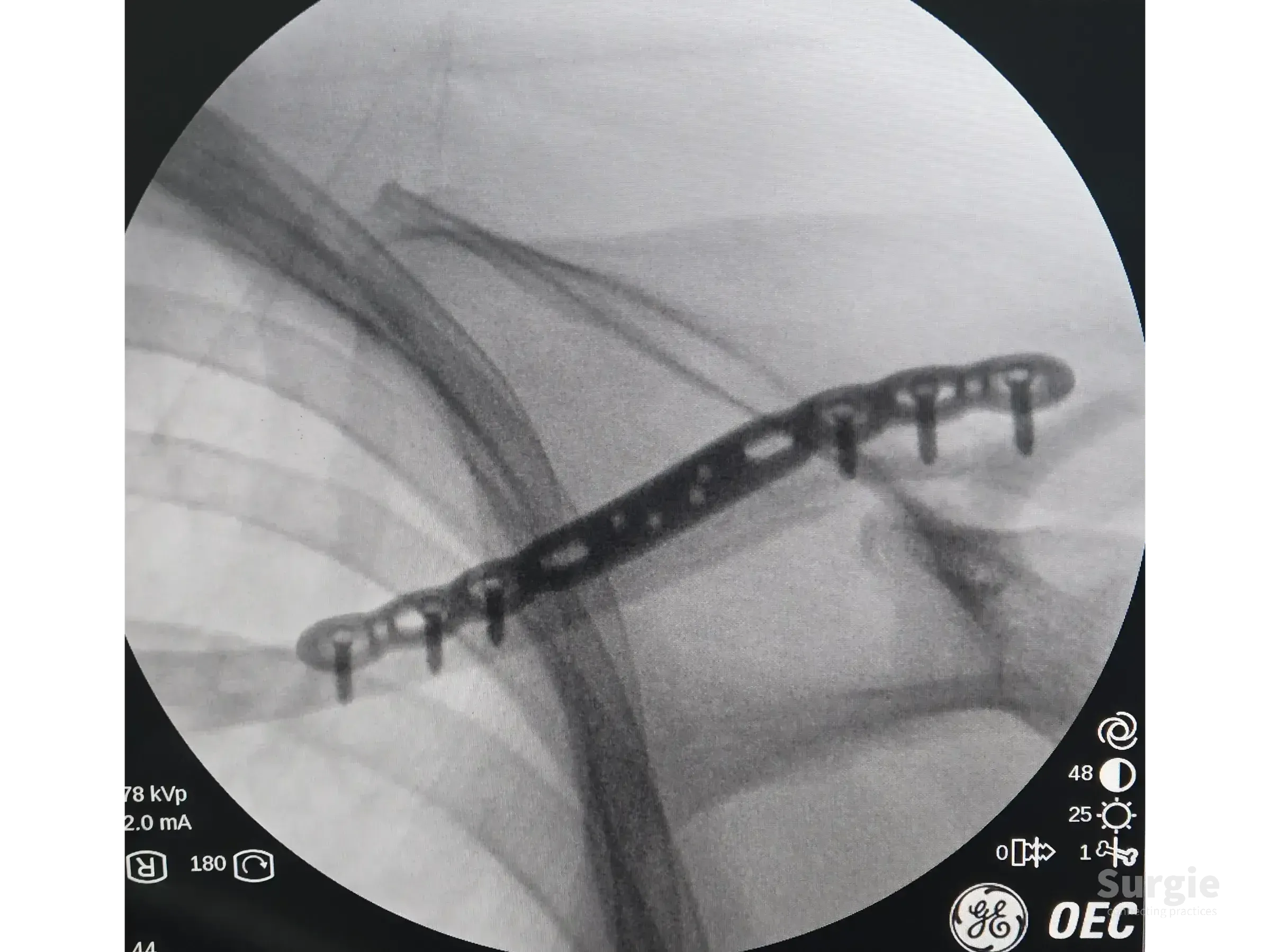 Fluoroscopic view of a metallic anatomic plate fixed to a fractured clavicle with cortical and locking screws.