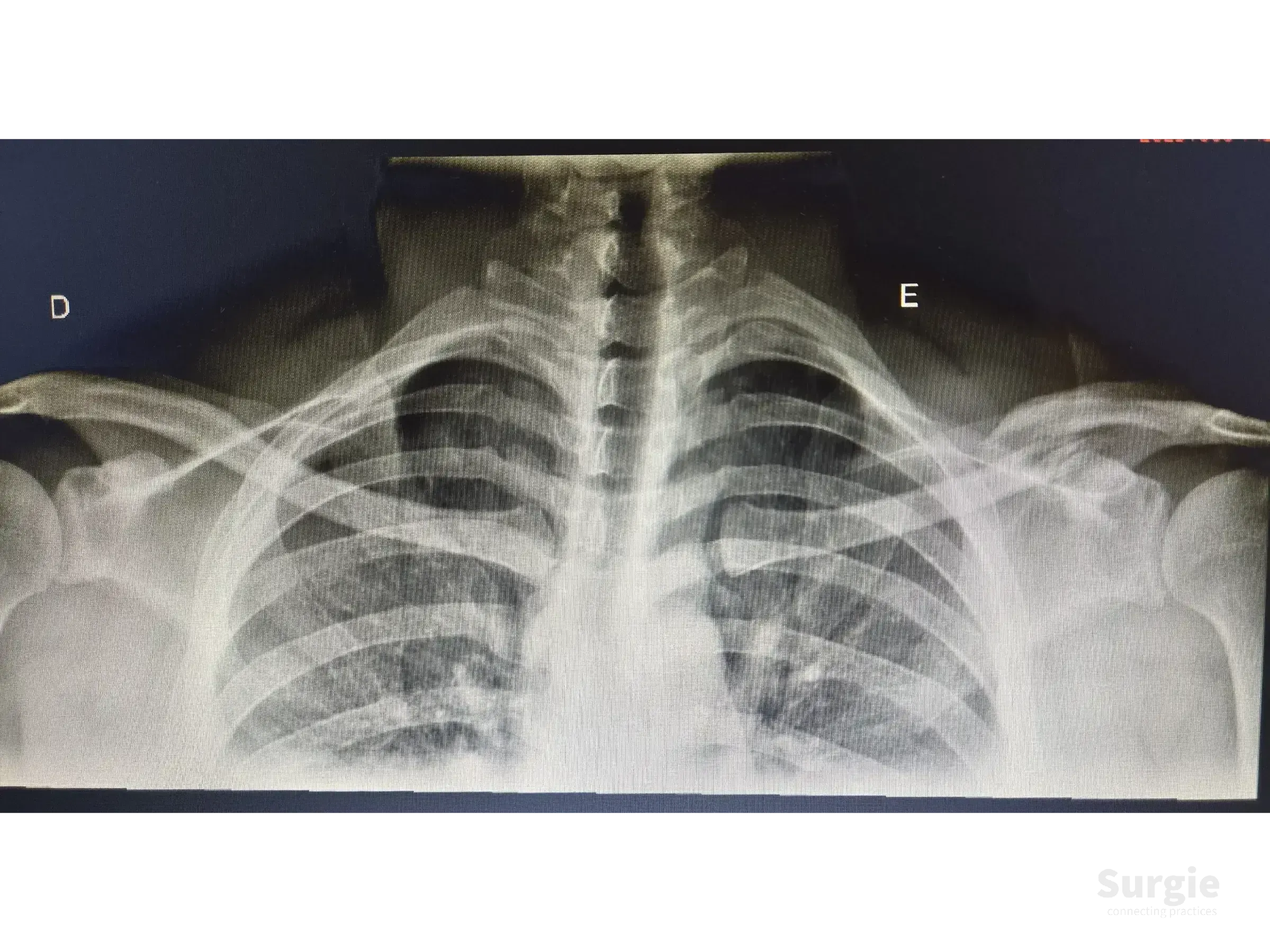 Anteroposterior chest X-ray showing a mid-shaft clavicle fracture with bone displacement and overlap.