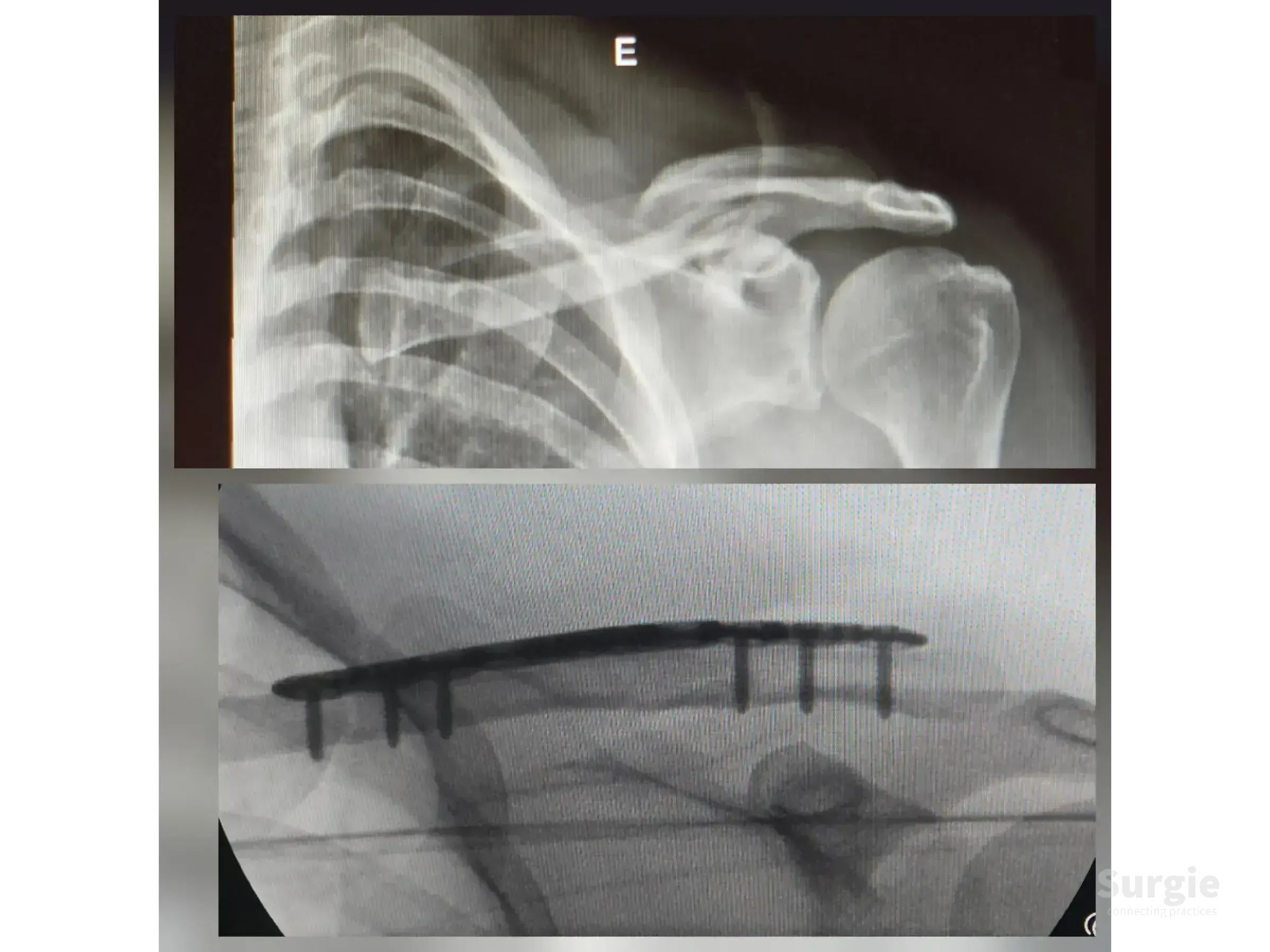 X-ray showing a mid-shaft clavicle fracture before and after surgical fixation with an anatomic plate and screws.
