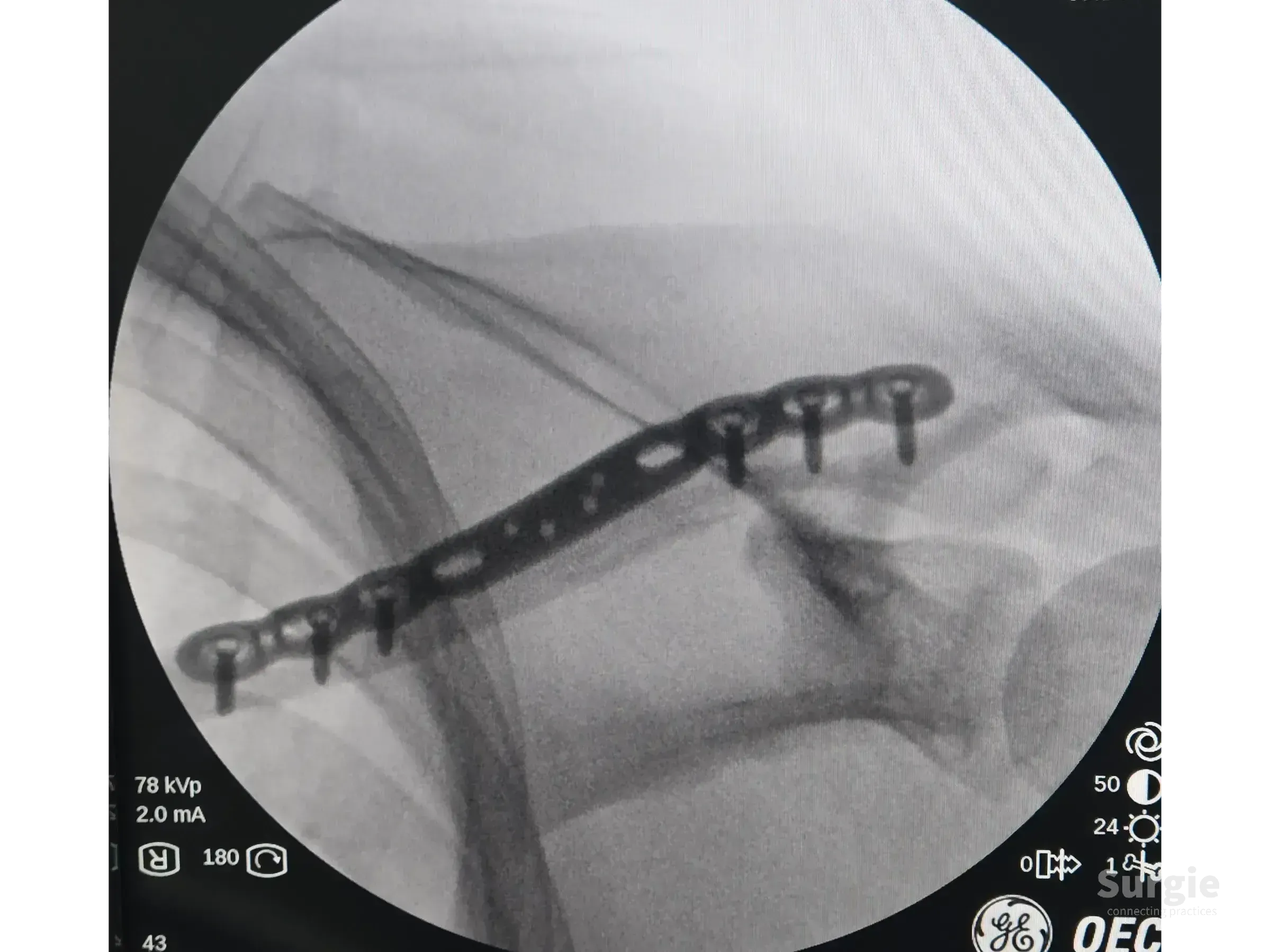 Fluoroscopic X-ray showing a metallic anatomic plate fixed to a fractured clavicle with cortical and locking screws.