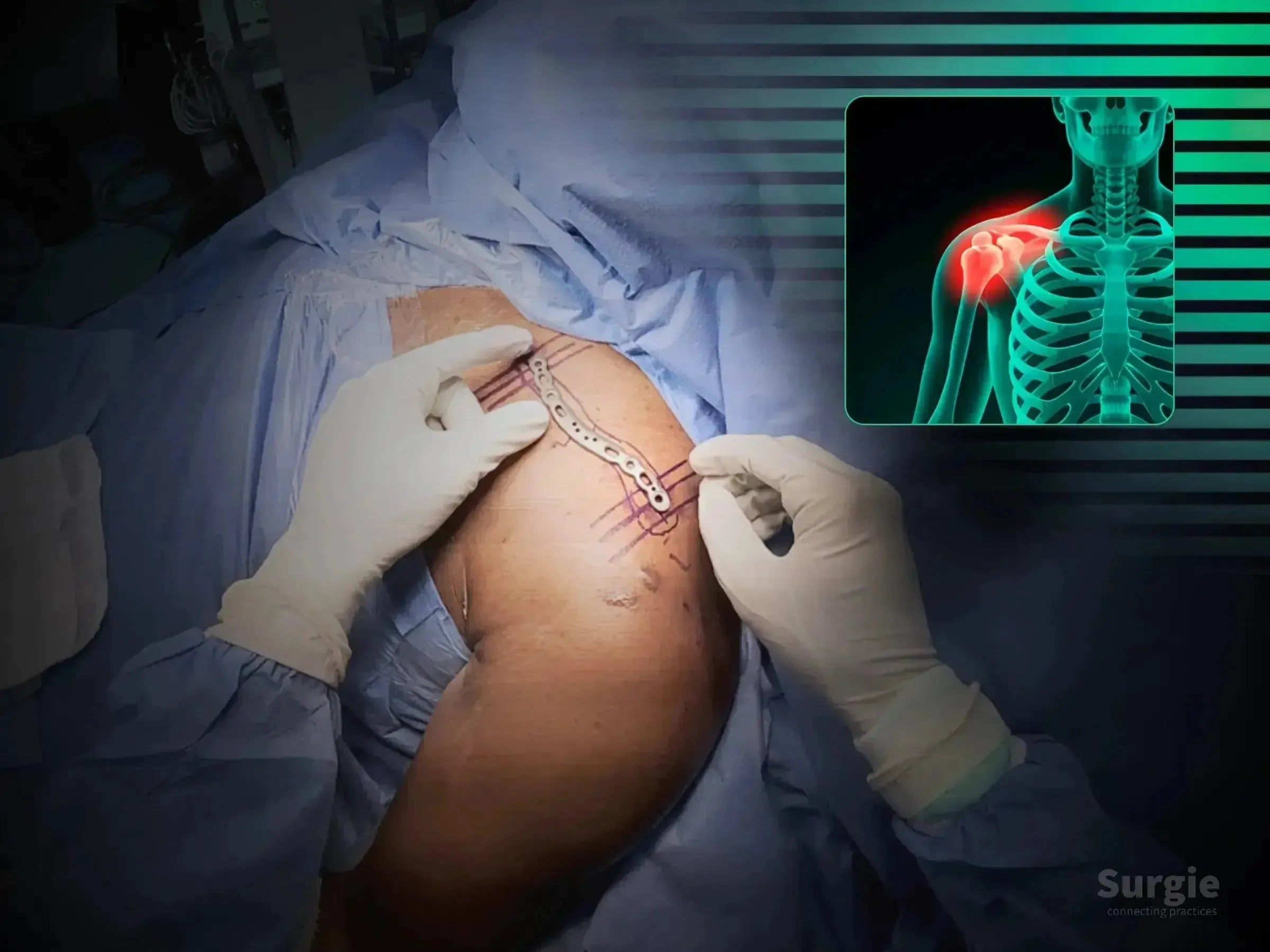 Surgeon placing a metallic anatomic clavicle plate on a patient with a skeletal diagram showing a shoulder fracture.