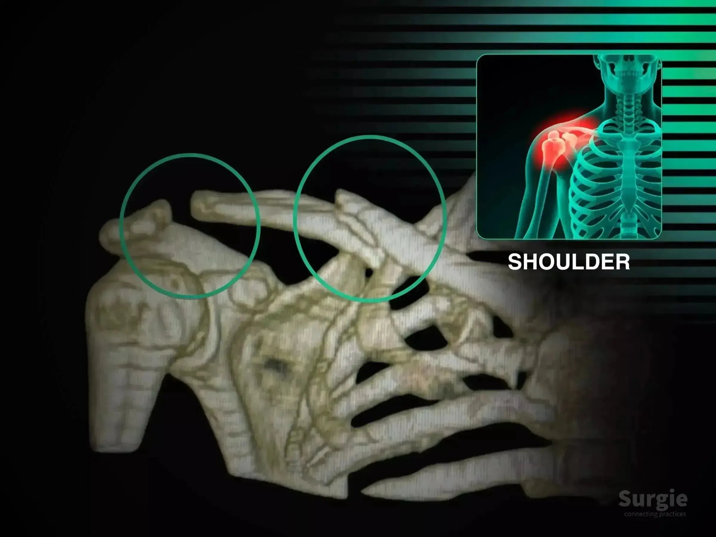 3D skeletal model showing clavicle fracture and acromioclavicular dislocation with highlighted surgical zones.