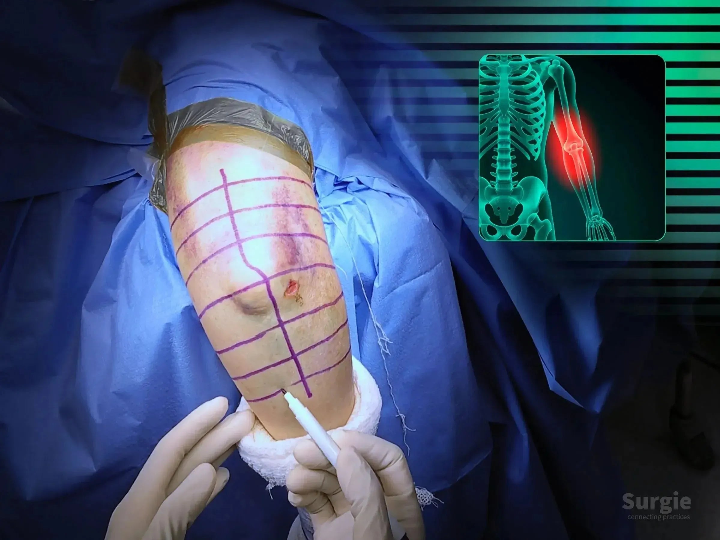Surgical marking on a patient's elbow with a distal humerus fracture overlay showing the injury site in a clinical setting.