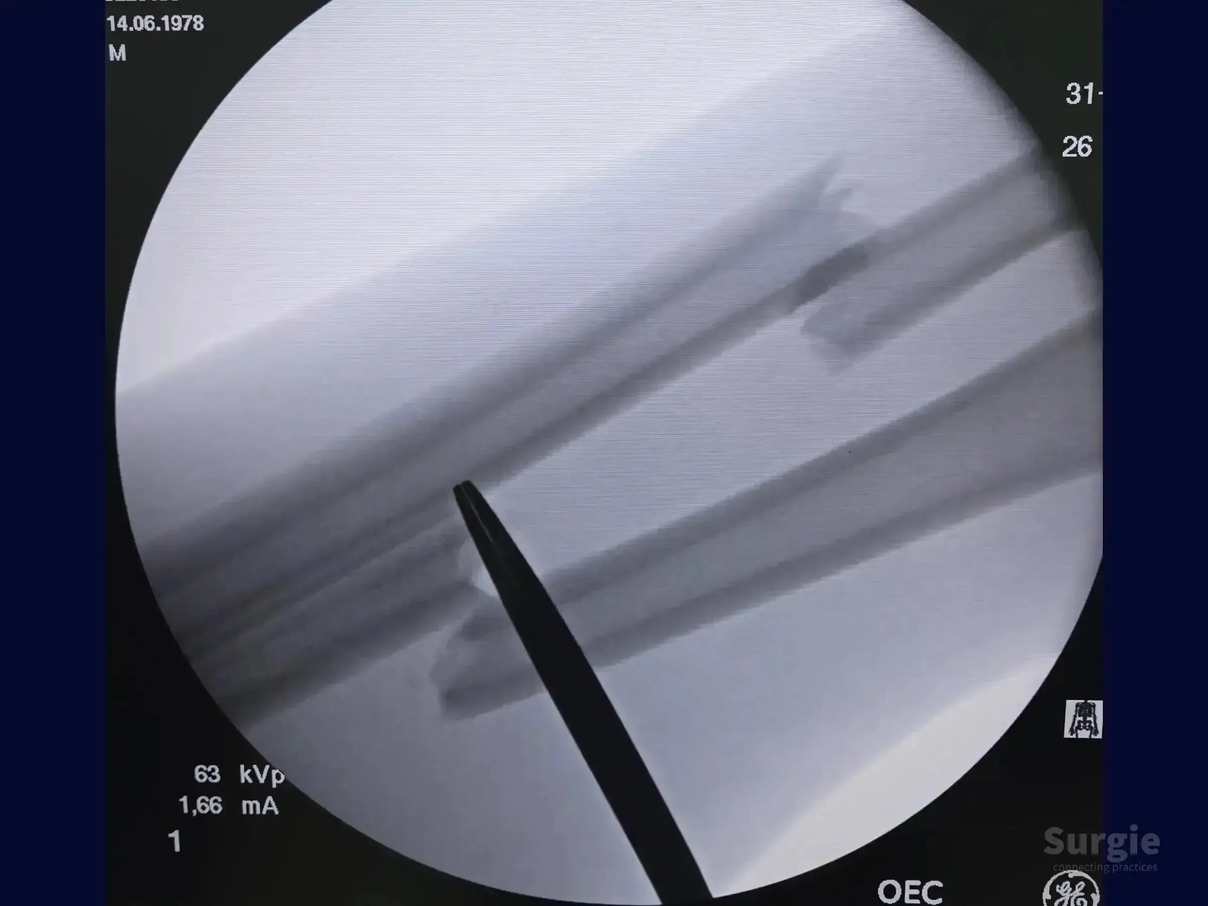 Fluoroscopic X-ray showing a diaphyseal fracture of the radius and ulna with a surgical instrument pointing to the site.