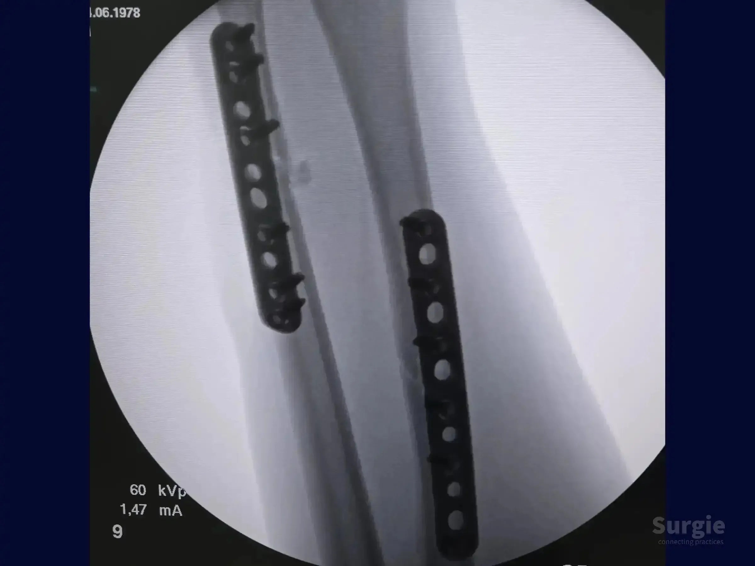 Fluoroscopic X-ray showing orthopedic metal plates and screws stabilizing radial and ulnar shaft fractures.