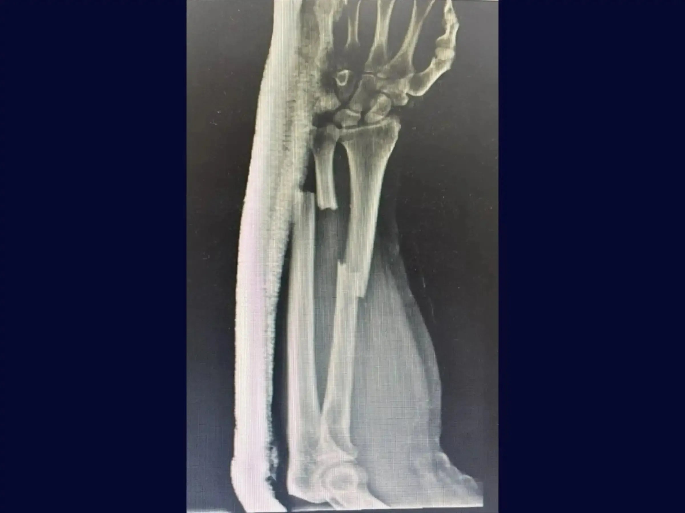 Diaphysäre Frakturen von Radius und Ulna