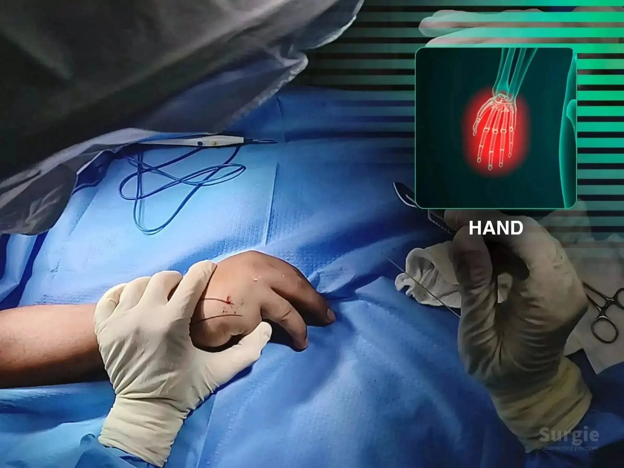 Surgeon in sterile gloves marking a patient's wrist for radial fracture surgery with an anatomical hand diagram overlay.
