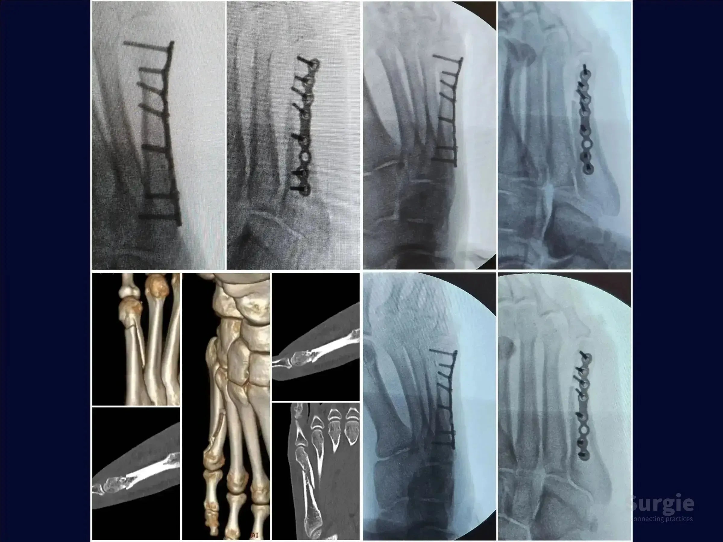 X-ray and 3D CT scans showing surgical fixation of a fifth metatarsal fracture using a metal plate and locking screws.