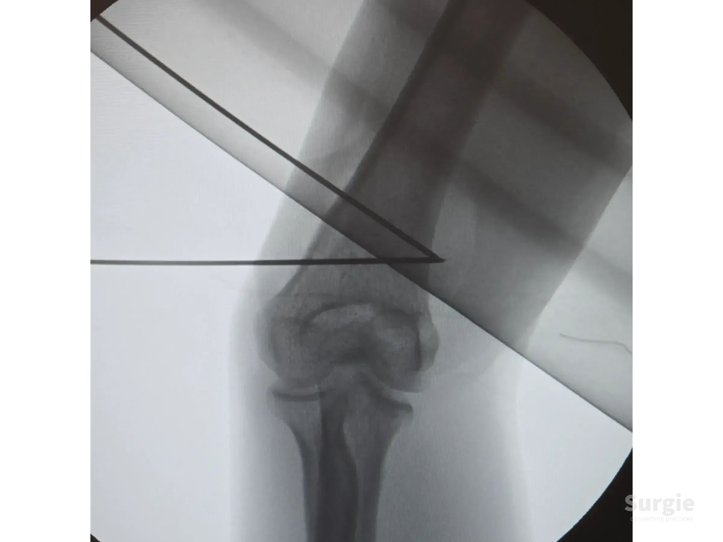 X-ray showing a distal humerus osteotomy with surgical guide wires for cubitus varus deformity correction.