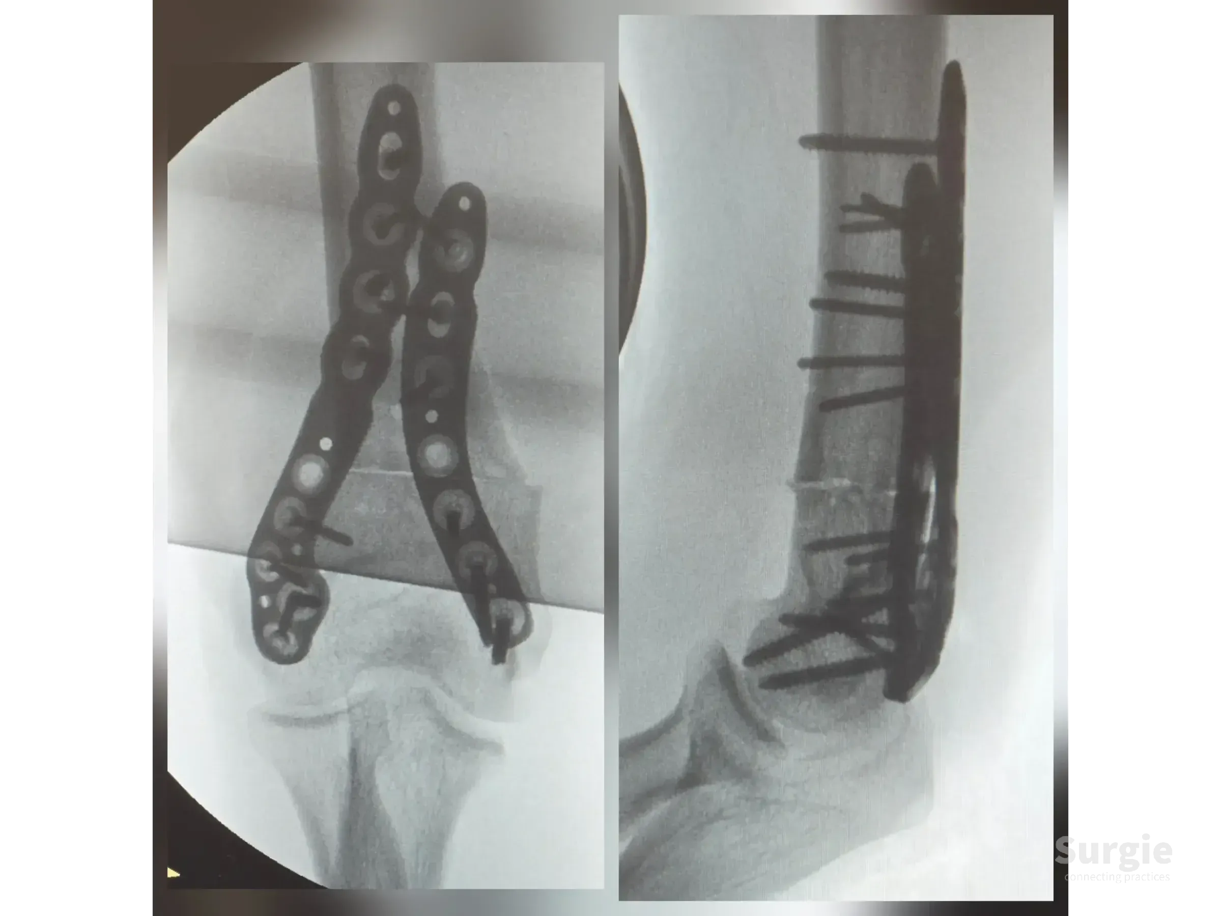 X-ray showing distal humerus osteotomy fixed with dual locking plates and screws for cubitus varus correction.