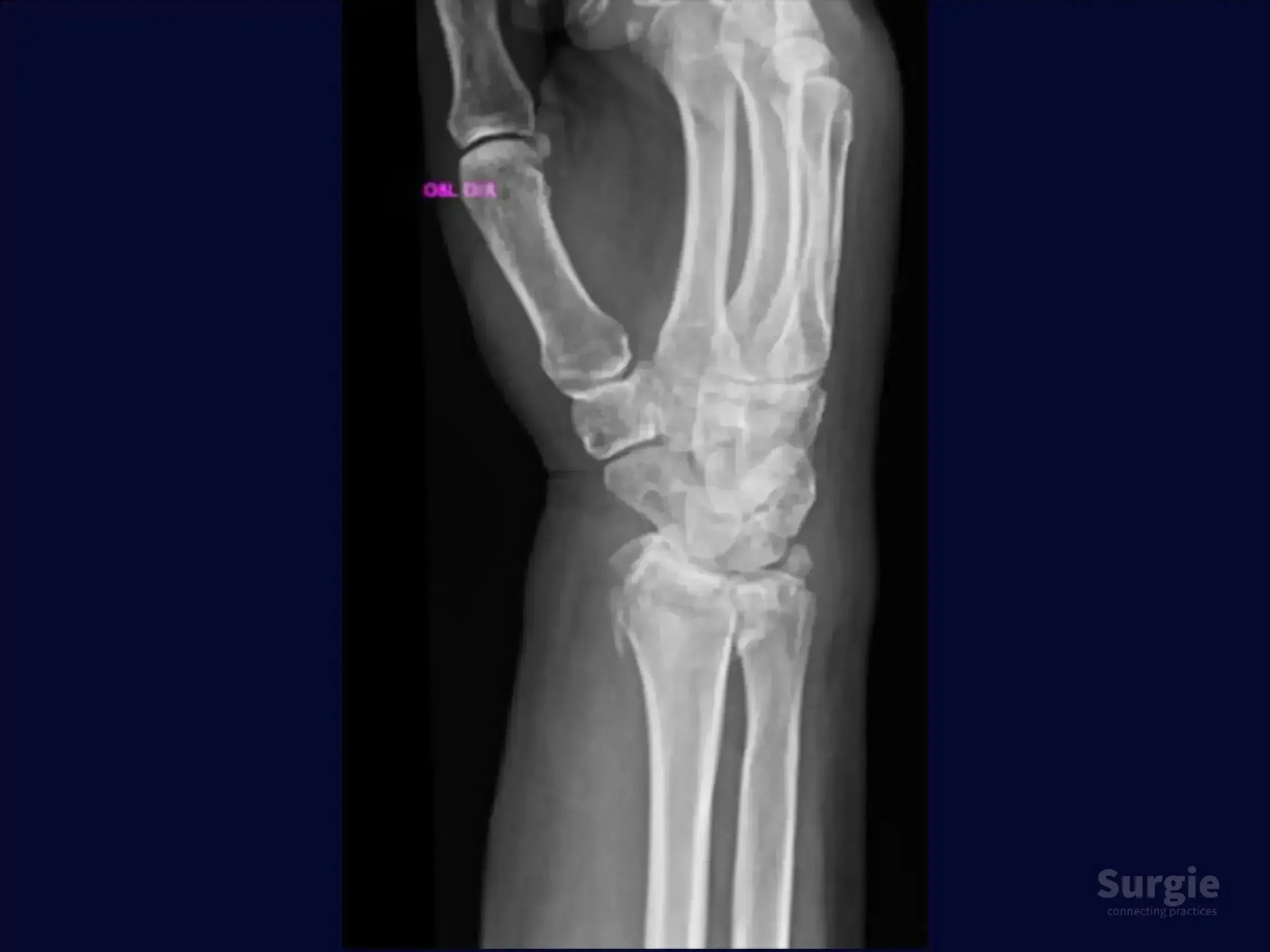 X-ray showing a distal radius fracture with dorsal displacement and comminution in a human wrist.