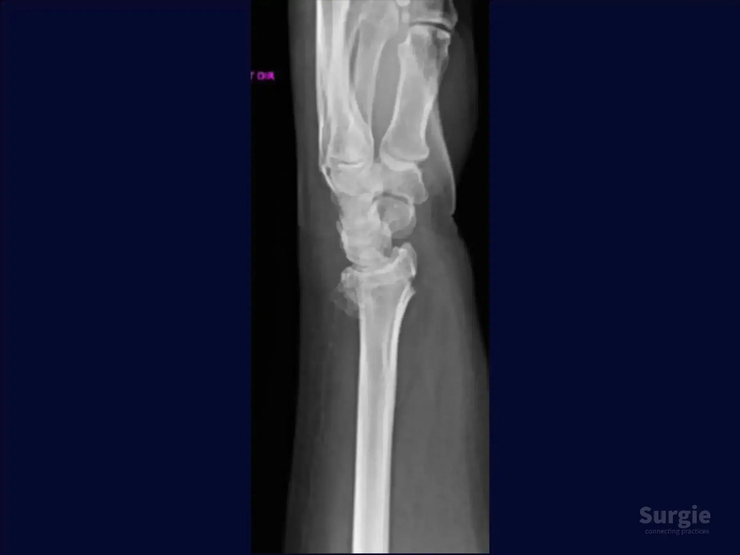 Lateral X-ray showing a distal radius fracture with dorsal comminution and displacement of the wrist joint.