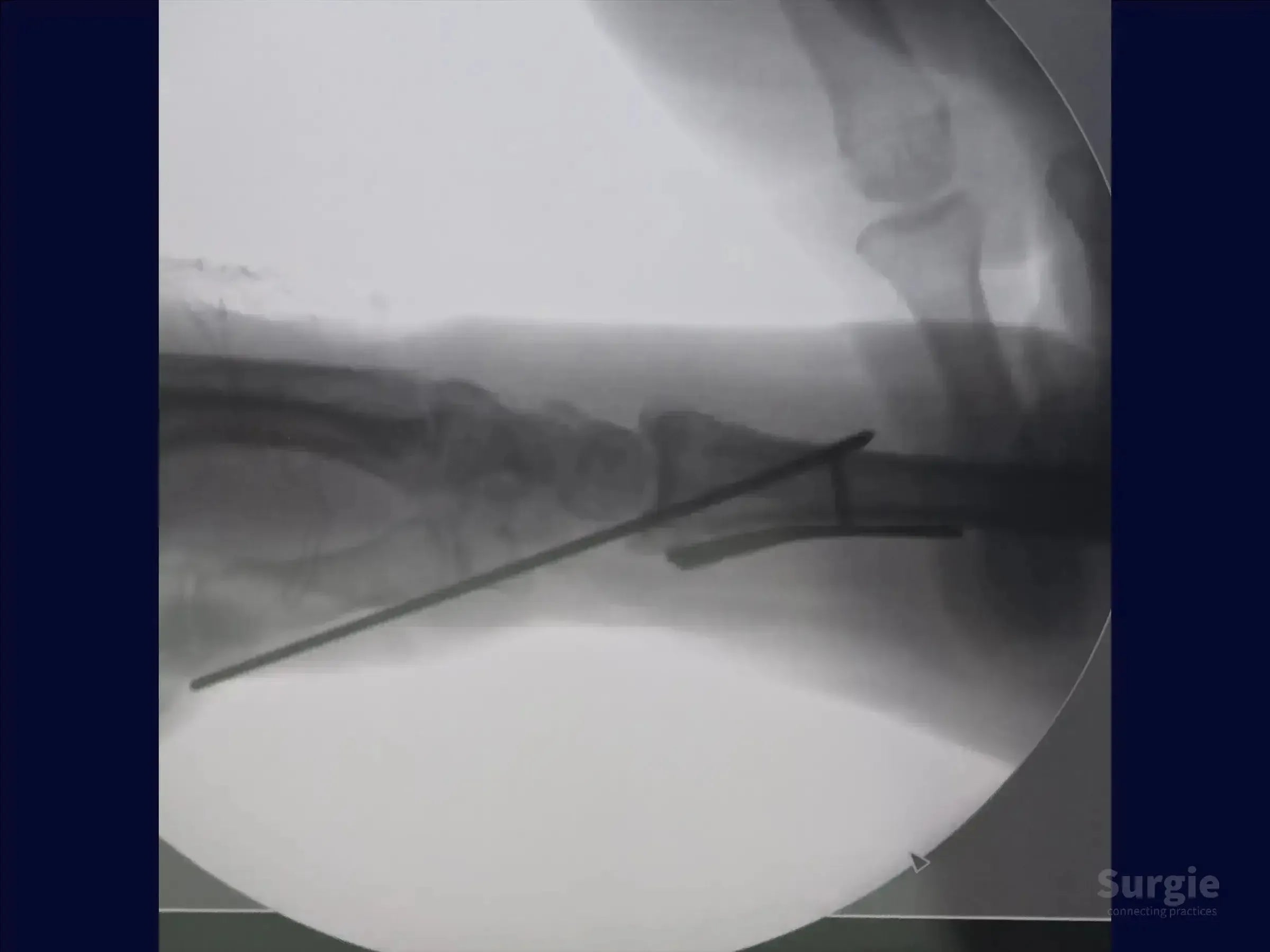 Lateral X-ray showing a distal radius fracture with a Kirschner wire and metal plate for surgical fixation.