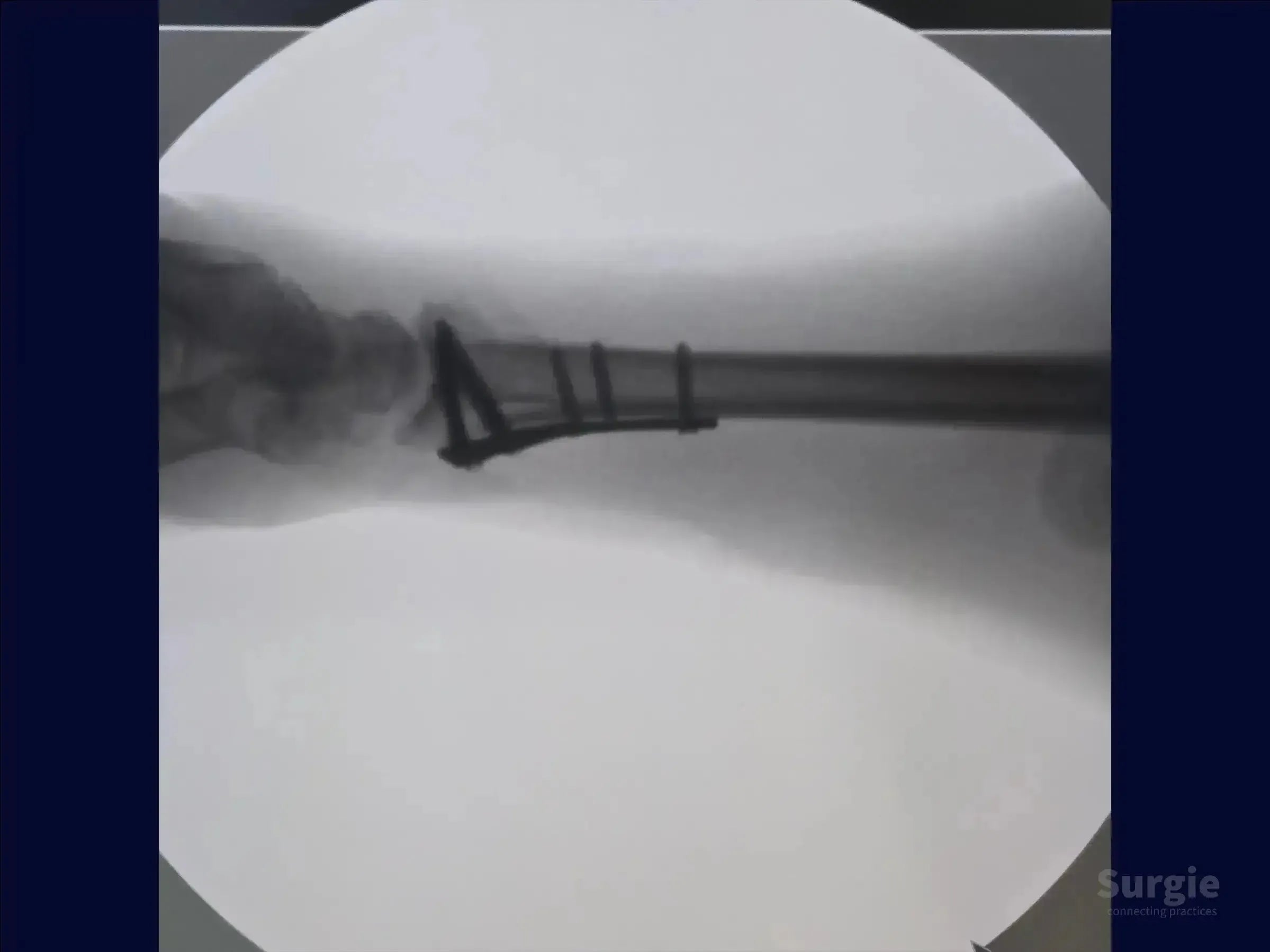 X-ray showing a distal radius fracture fixed with a volar locking plate and screws for anatomical reduction.