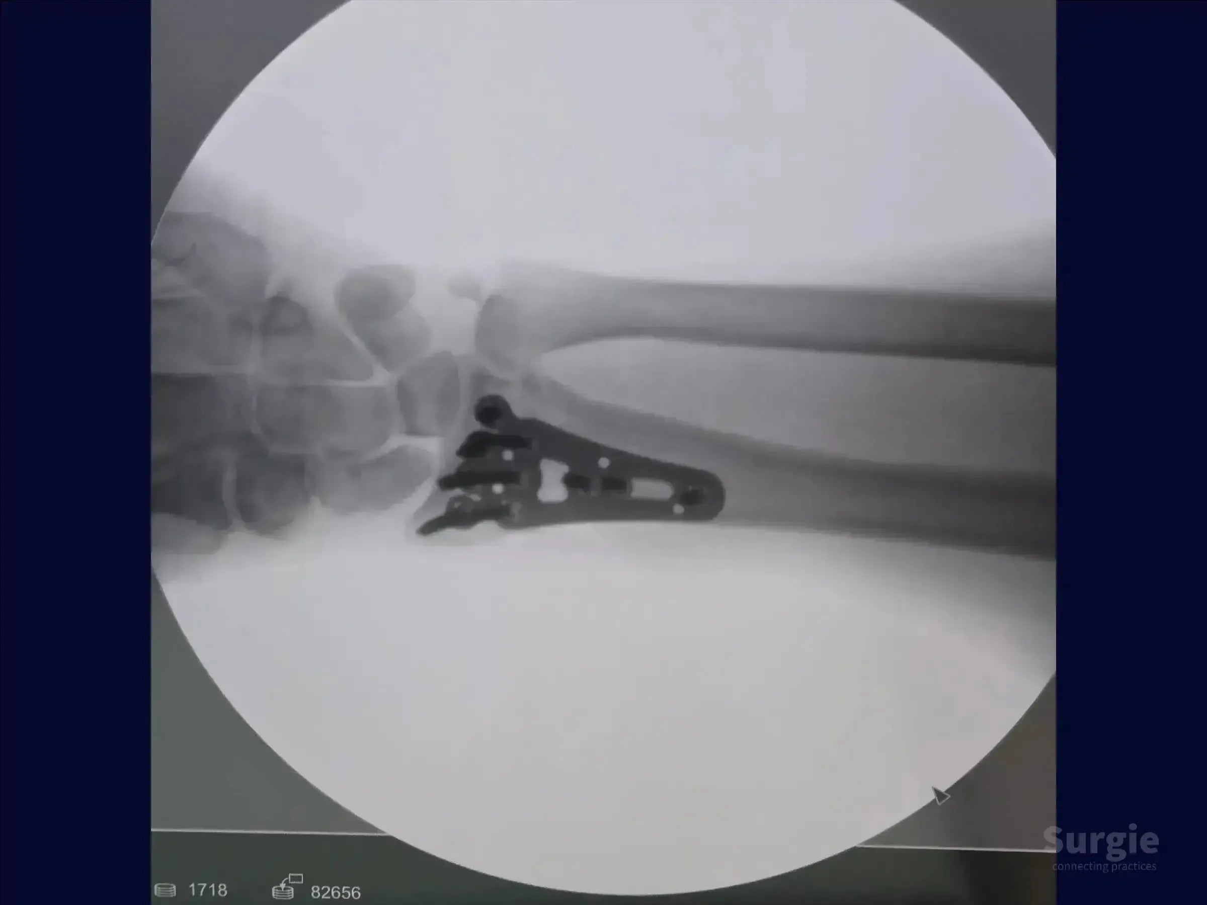 X-ray showing a metal volar plate fixed to a distal radius fracture with screws for anatomical reduction.