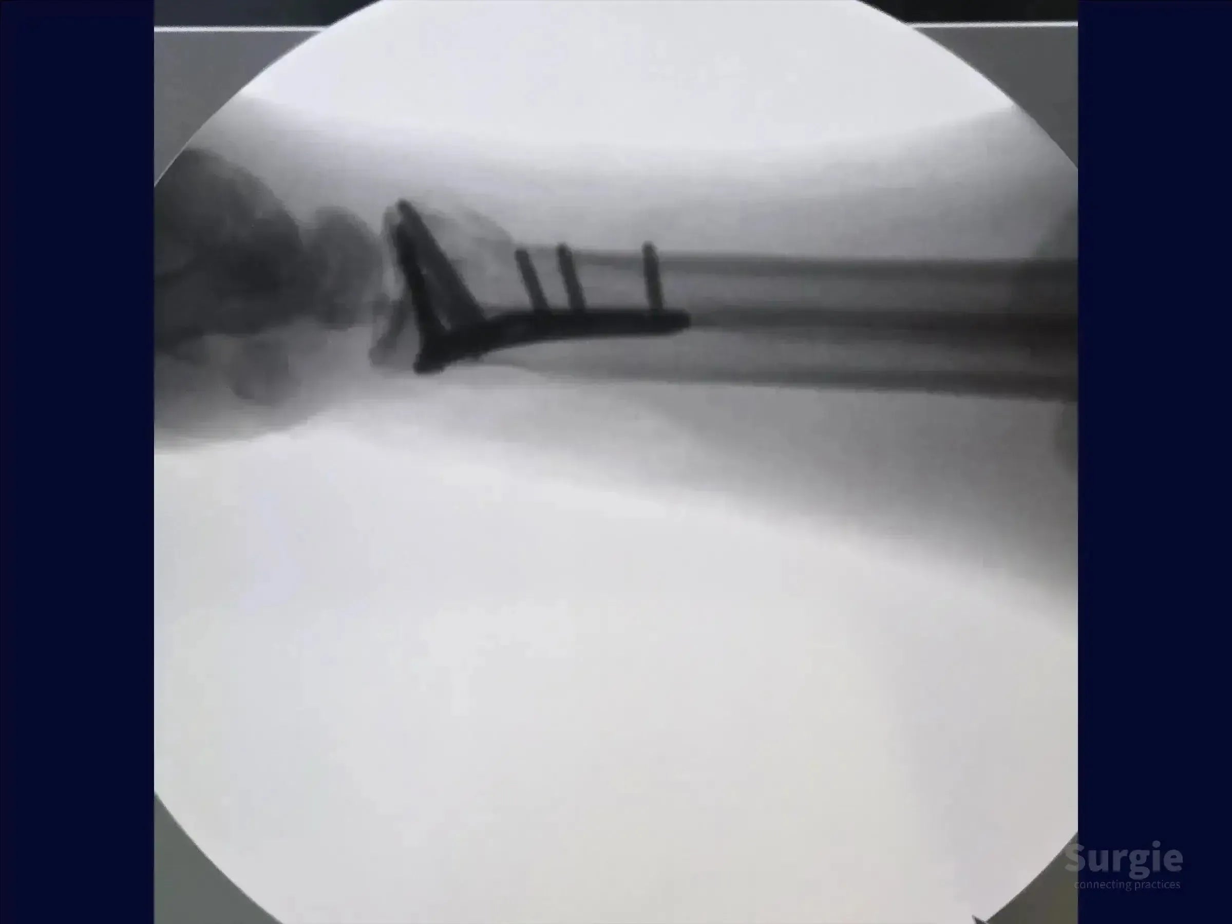 X-ray showing a metal volar plate fixed to a distal radius fracture with screws for anatomical reduction.