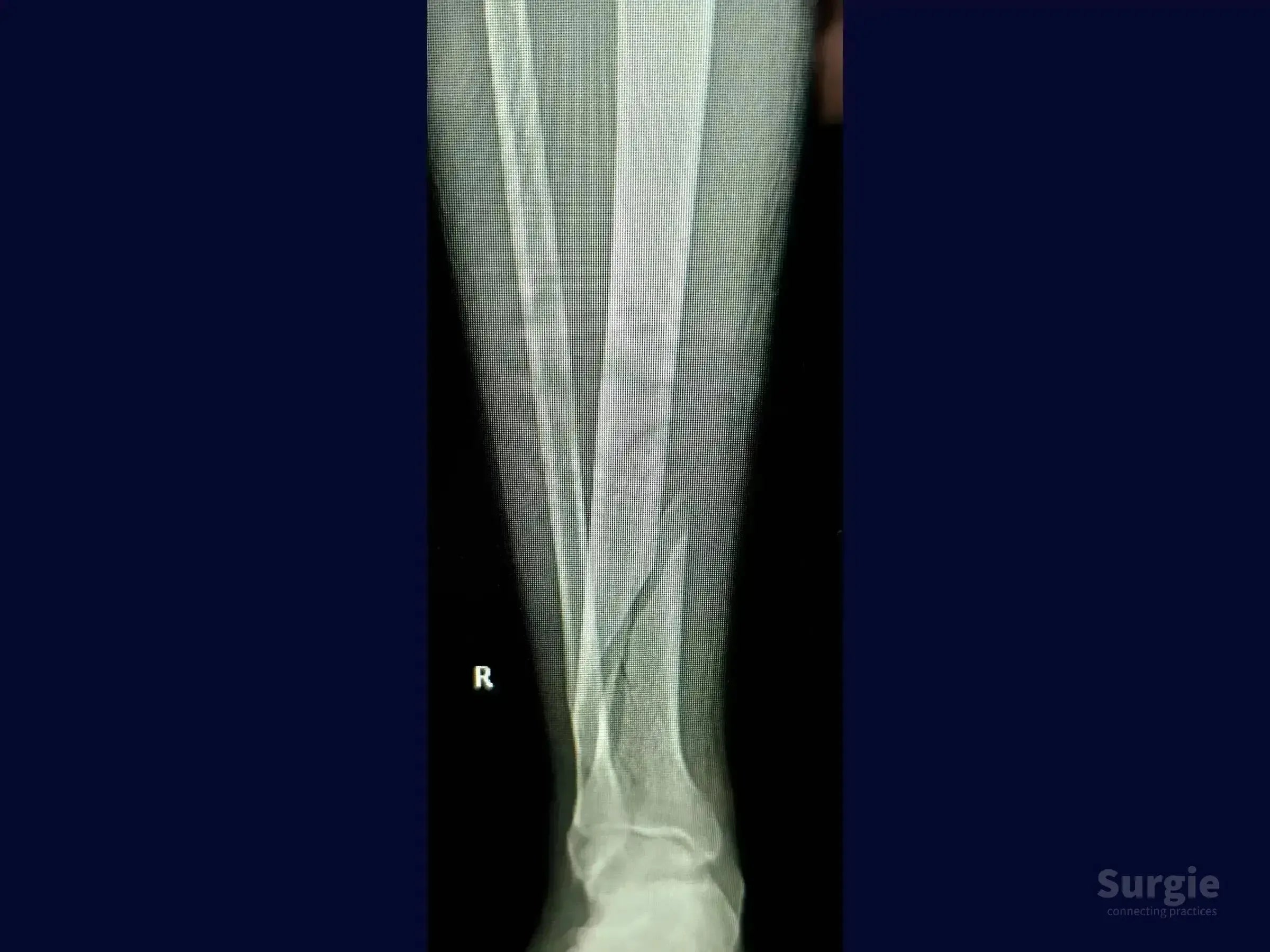 X-ray showing a right distal tibial shaft fracture with a long oblique pattern and associated fibular fracture.