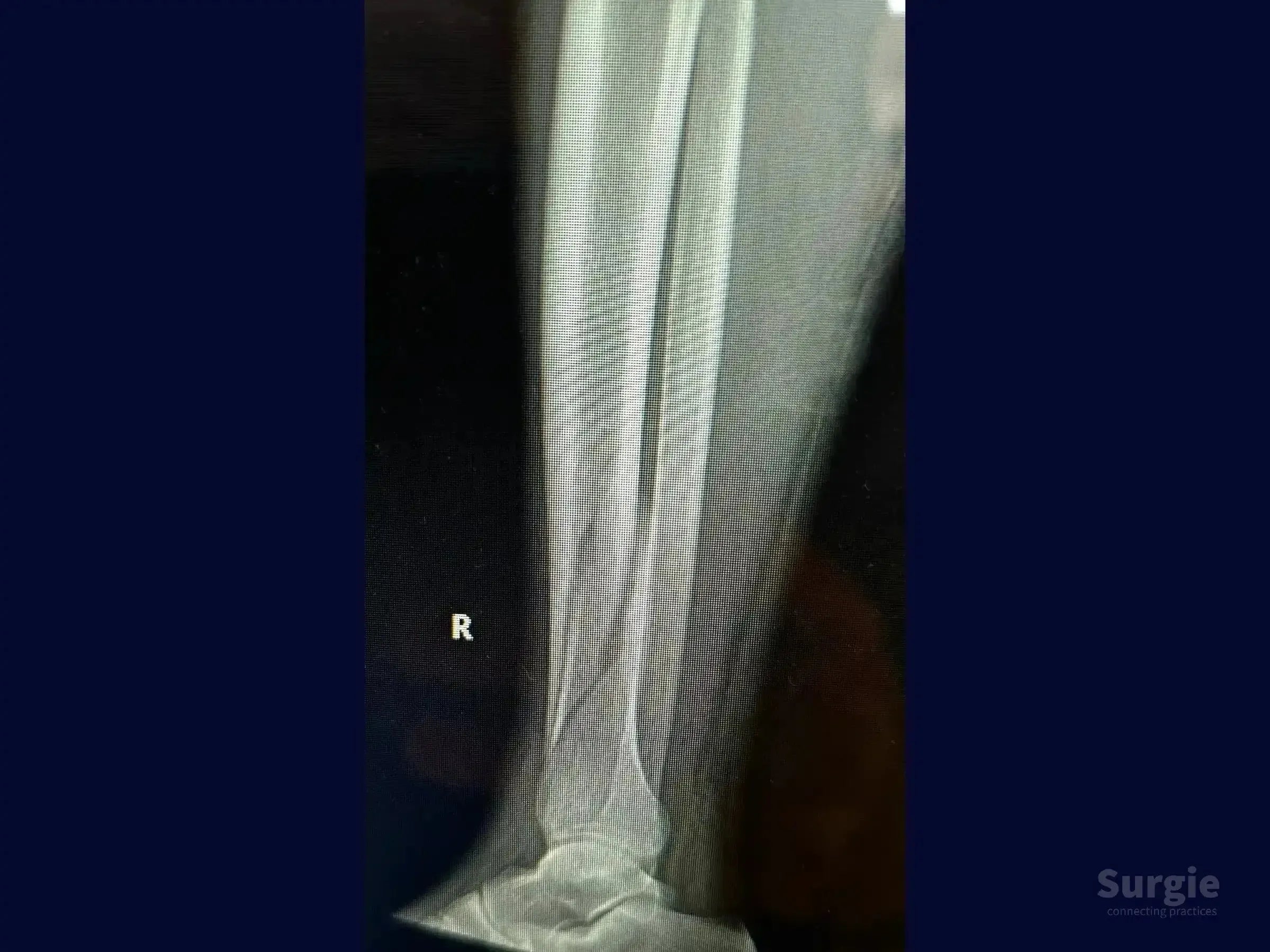 X-ray showing a right distal tibia fracture with a long oblique pattern and associated fibular fracture.