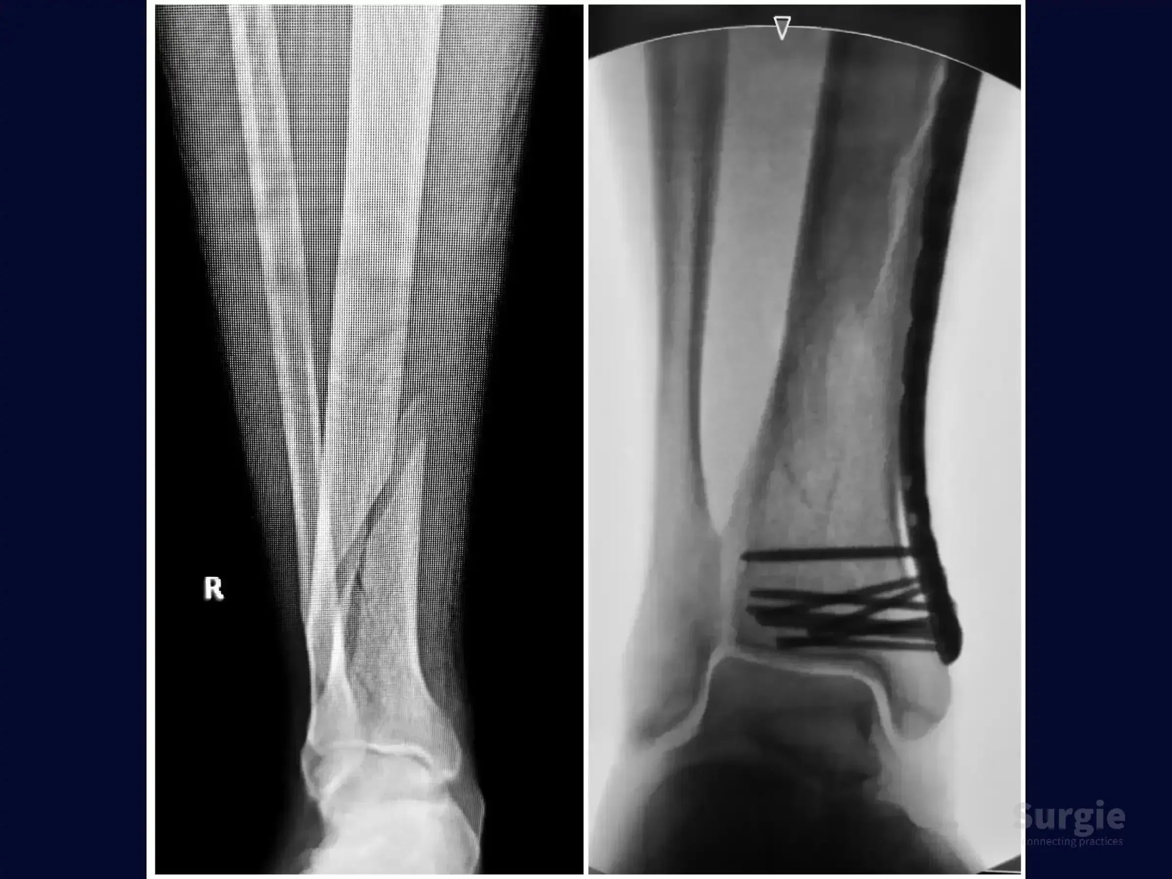 X-ray comparison of a distal tibia fracture before and after surgical fixation with an anatomic locked plate.