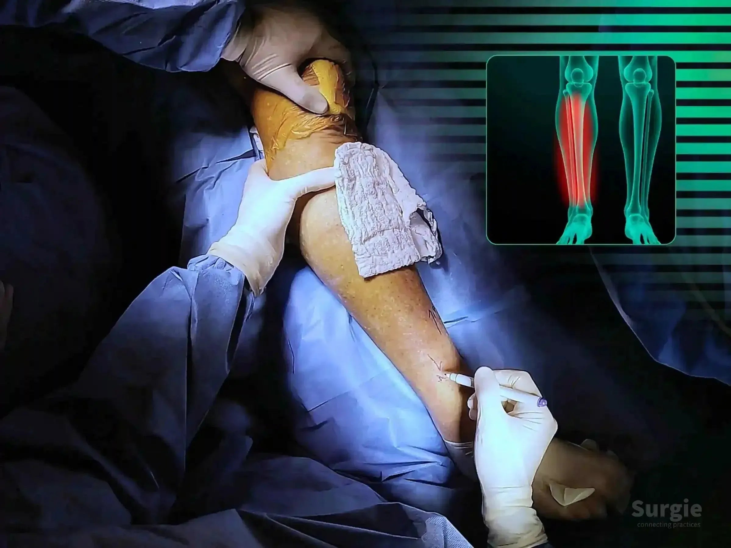 Surgeon marking a distal tibia fracture site for minimally invasive surgery with a digital X-ray overlay of the leg.