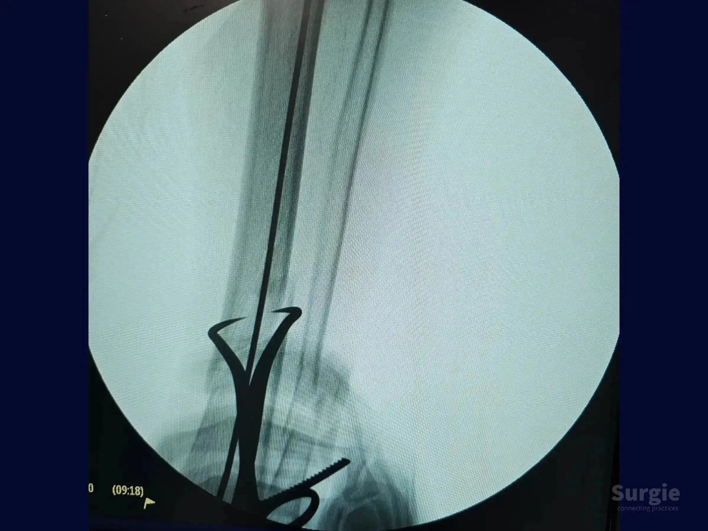 Fluoroscopic view of a distal tibial fracture stabilized with an intramedullary nail via a suprapatellar approach.