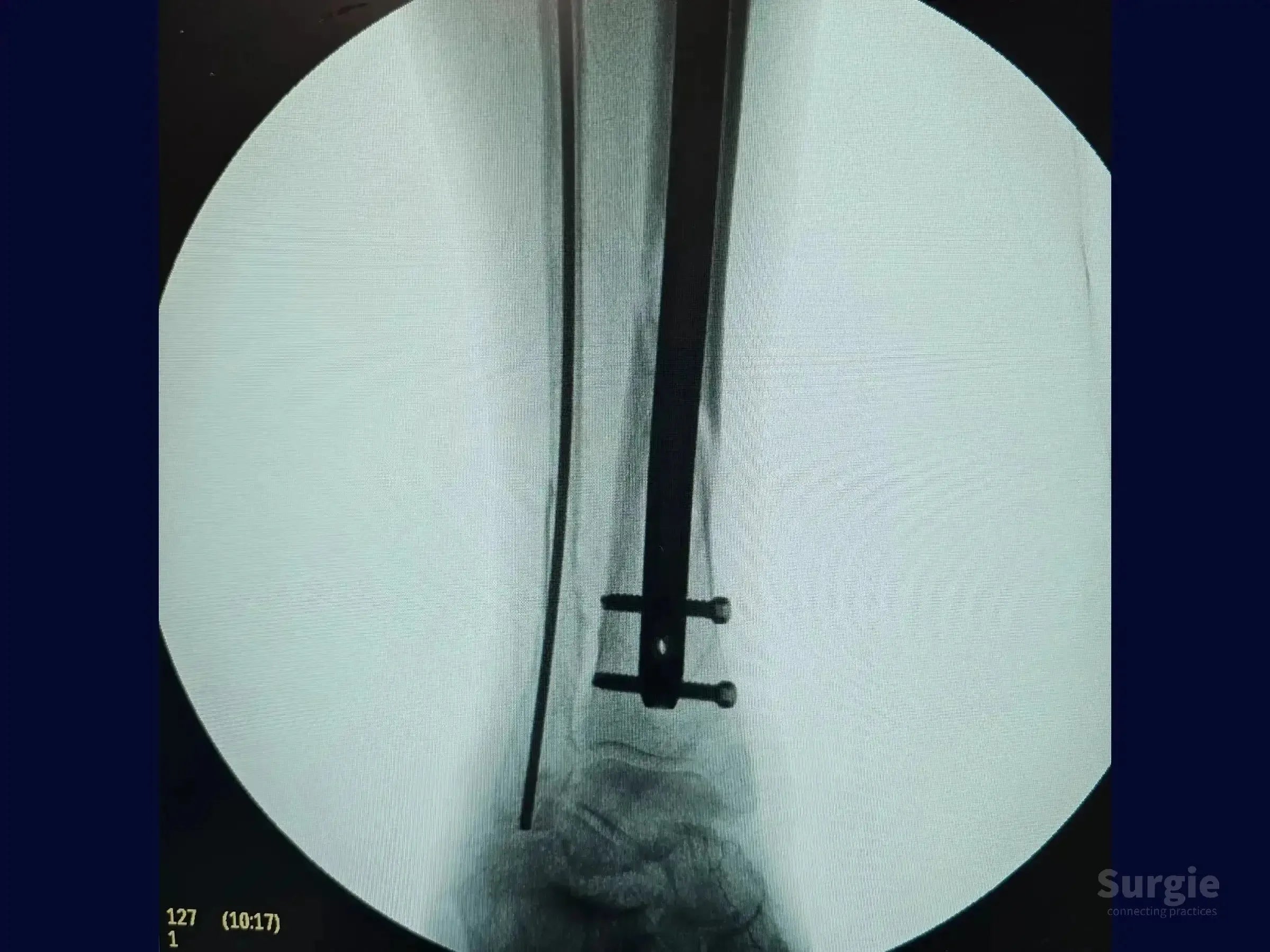 X-ray showing a metal intramedullary nail fixed with two distal locking screws in a tibial shaft fracture.
