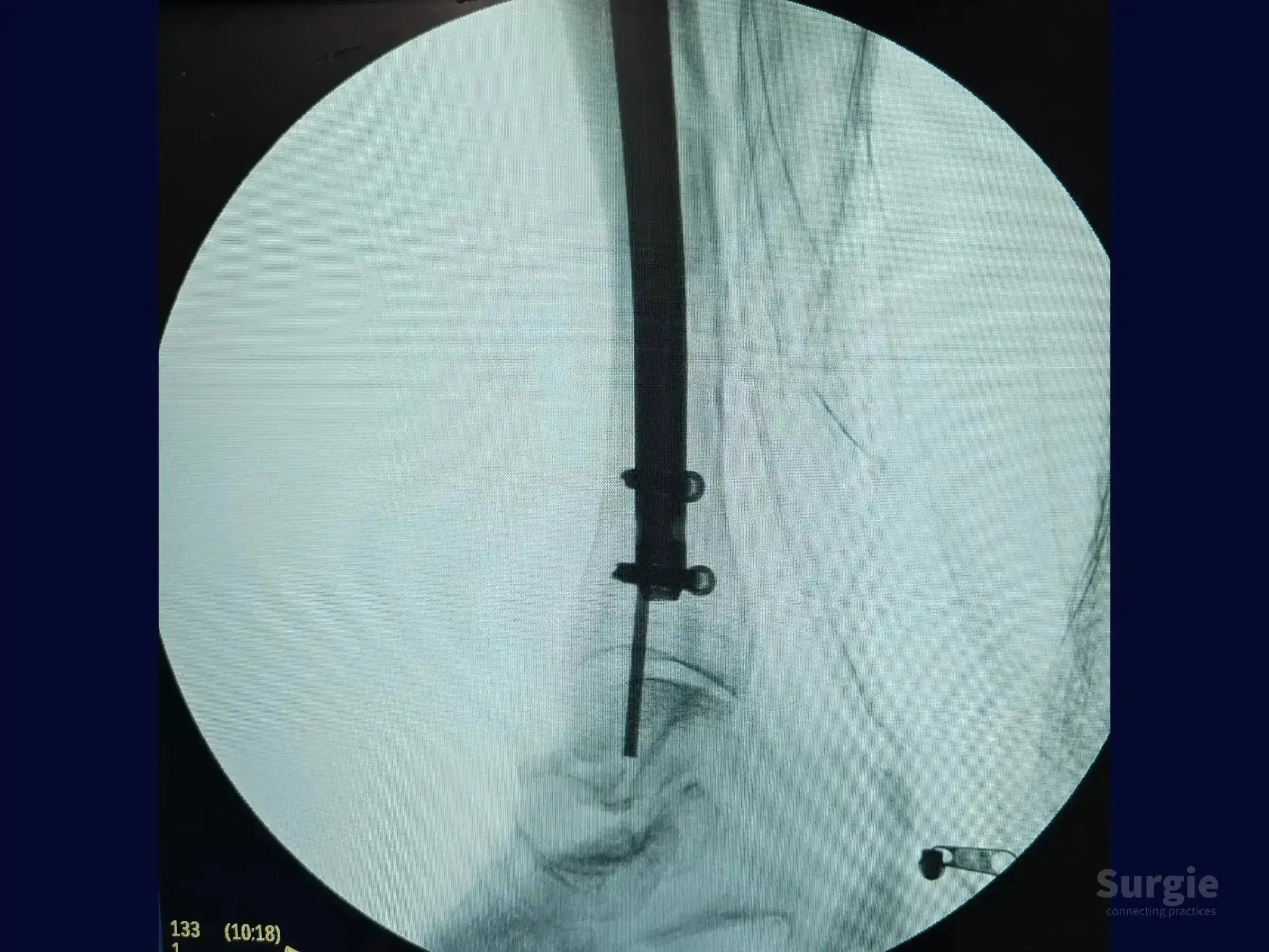 Fluoroscopic view of a distal tibial fracture stabilized with an intramedullary nail using a suprapatellar approach.