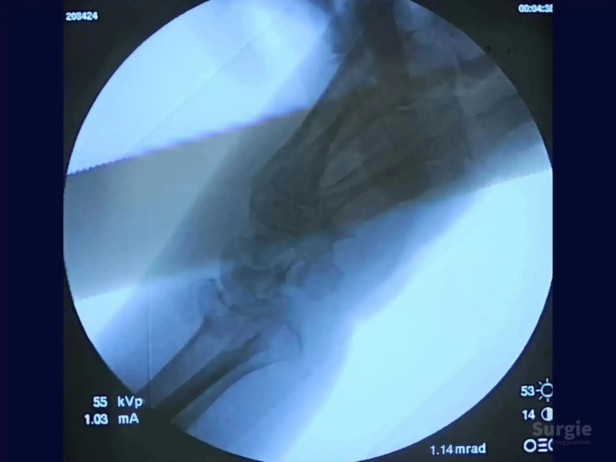 Fluoroscopic X-ray showing a dorsal Barton's fracture of the radius with articular displacement and wrist misalignment.