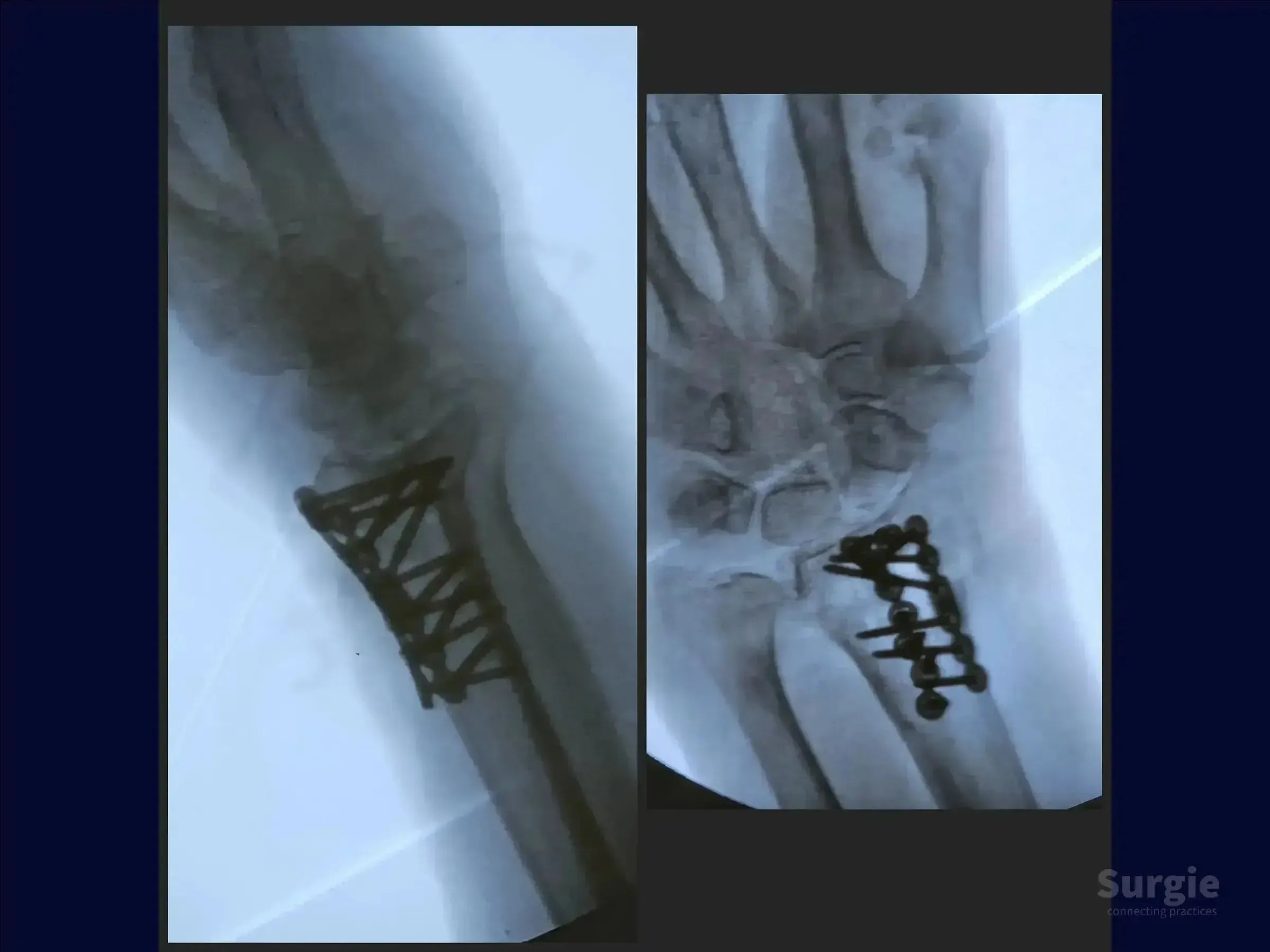 X-ray showing dorsal Barton's fracture of the radius stabilized with a metal plate and screws for wrist fixation.