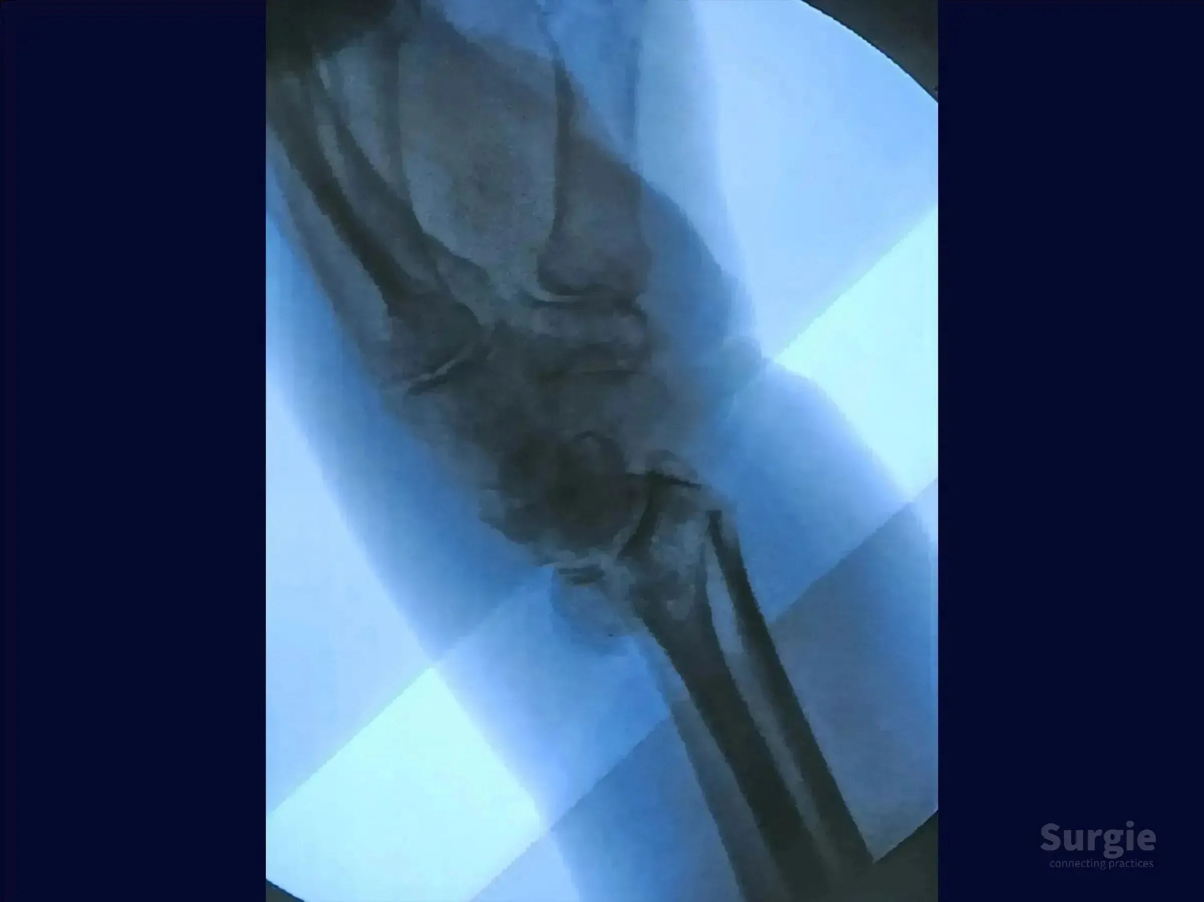 Lateral X-ray showing a dorsal Barton's fracture of the radius with articular displacement and wrist misalignment.